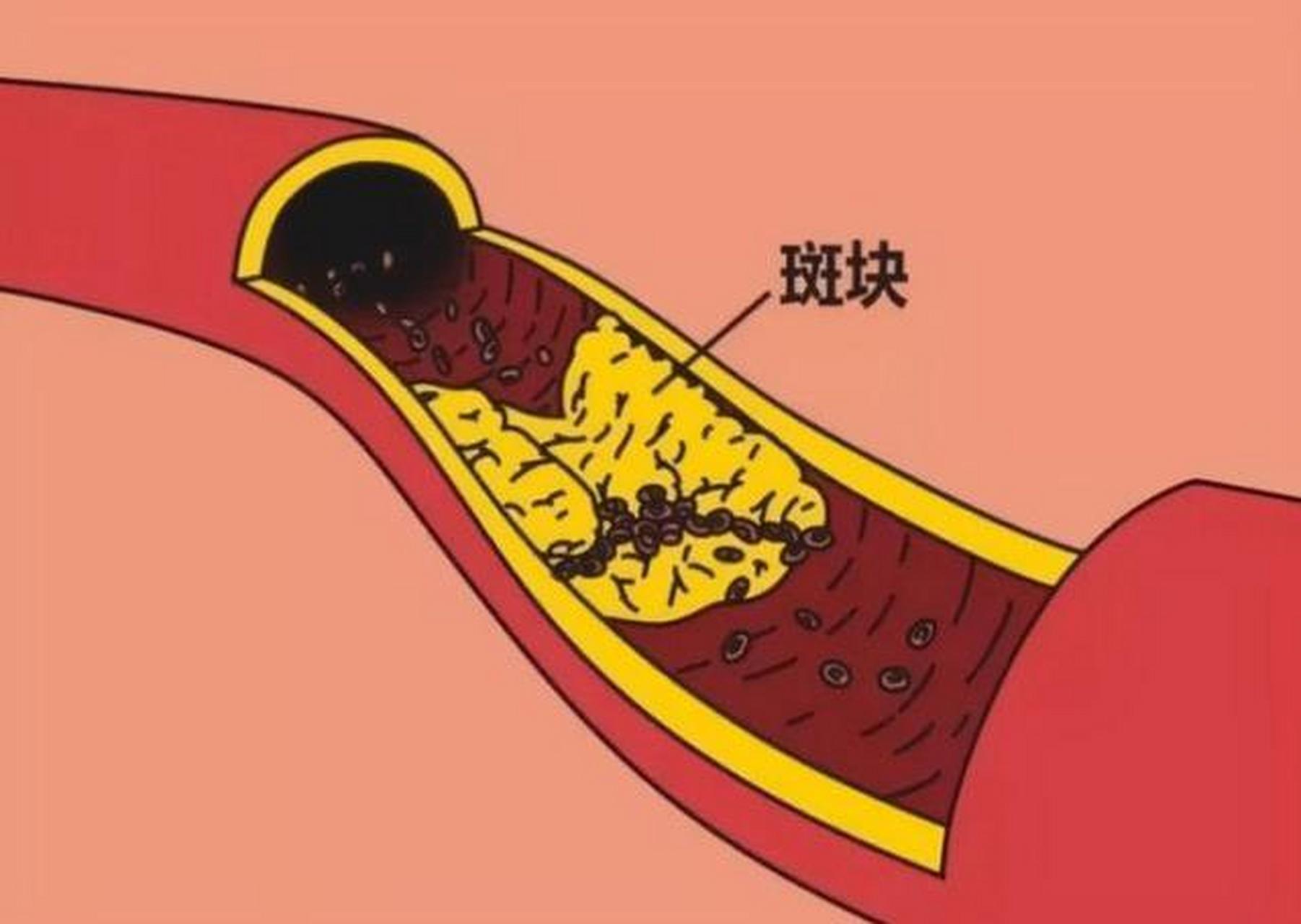 发现动脉硬化斑块,就离心梗不远了?分3种情况!  1.动脉硬化斑块会使血