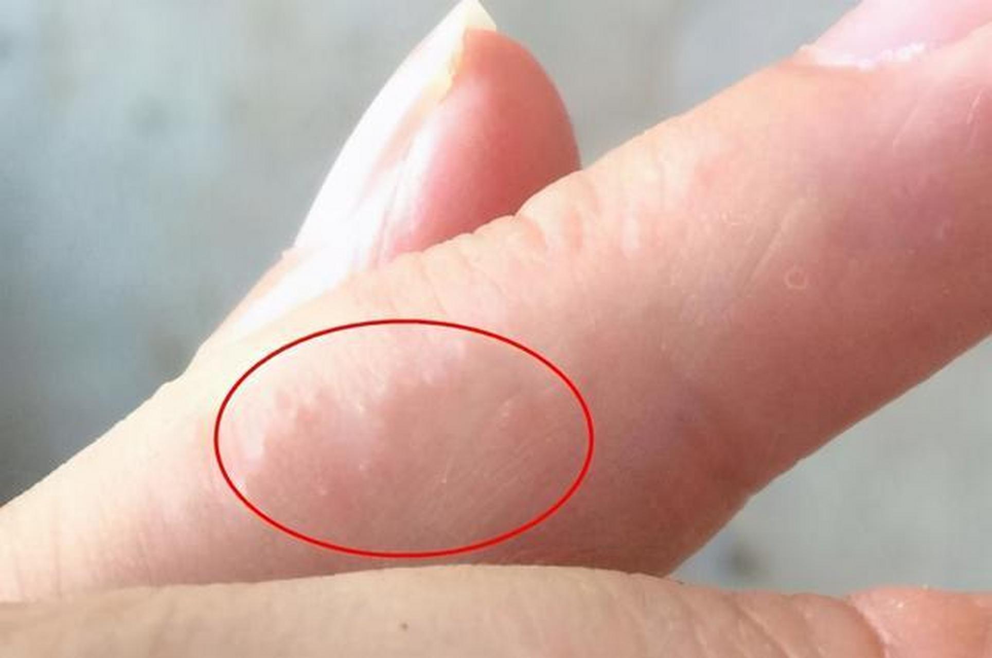 湿气重的人,手上会有这3种表现  1,指缝长小水泡 不管男女,手指缝中