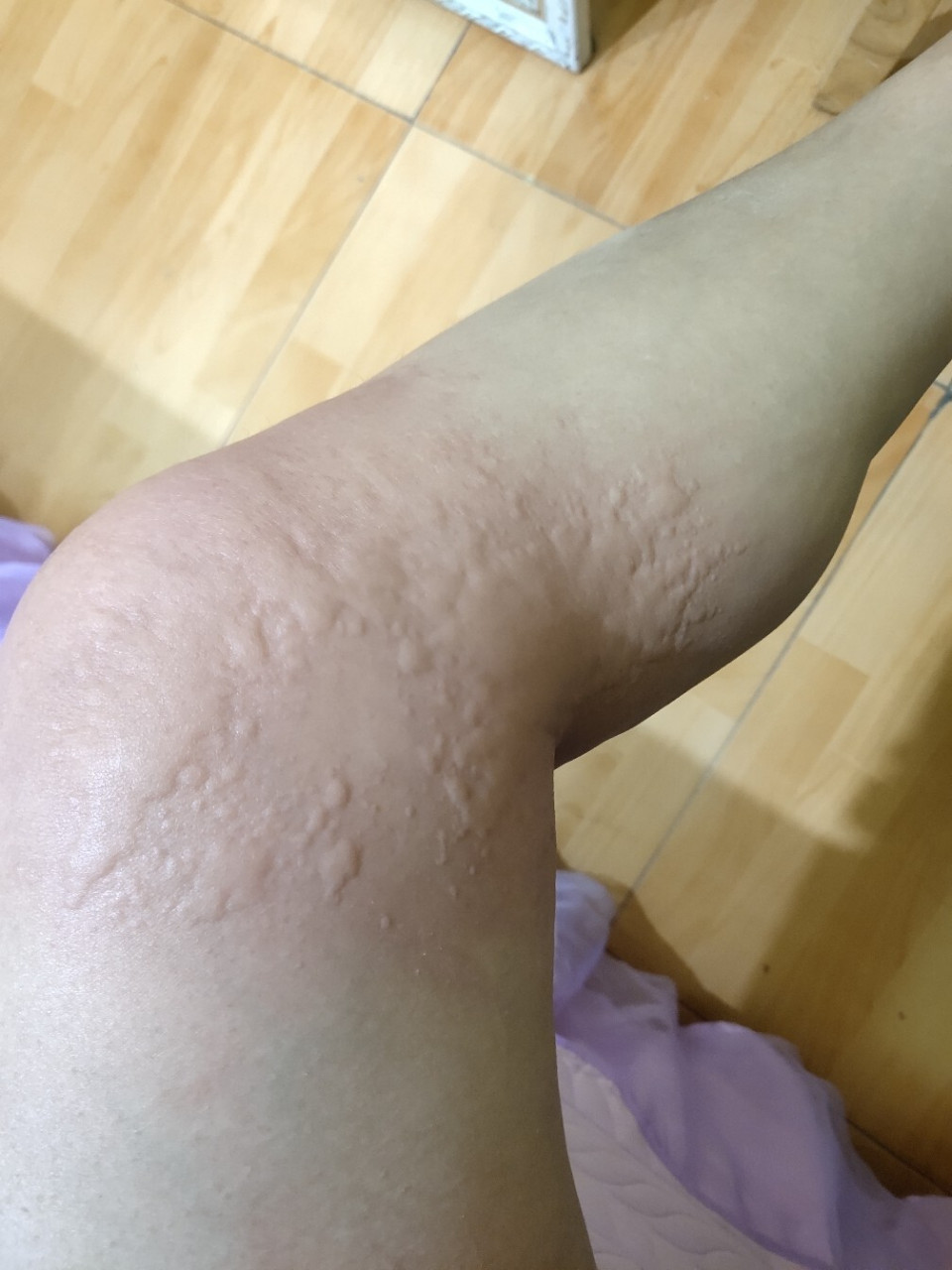 就这段时间开始,身上莫名的痒,开始以为是蚊子叮的包,一抓就一大个包