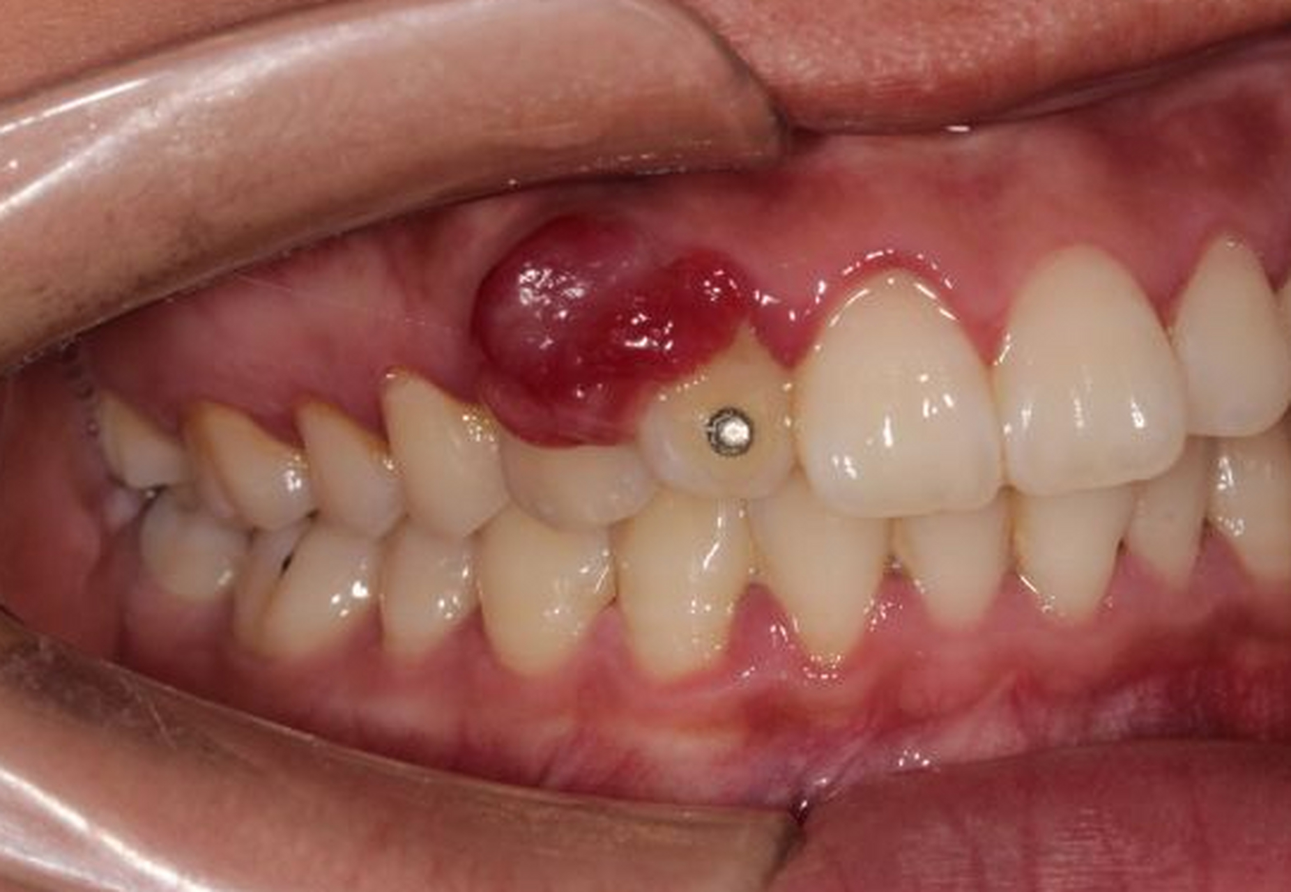 24岁的小赵,怀孕12周了,最近,她发现自己牙龈上有