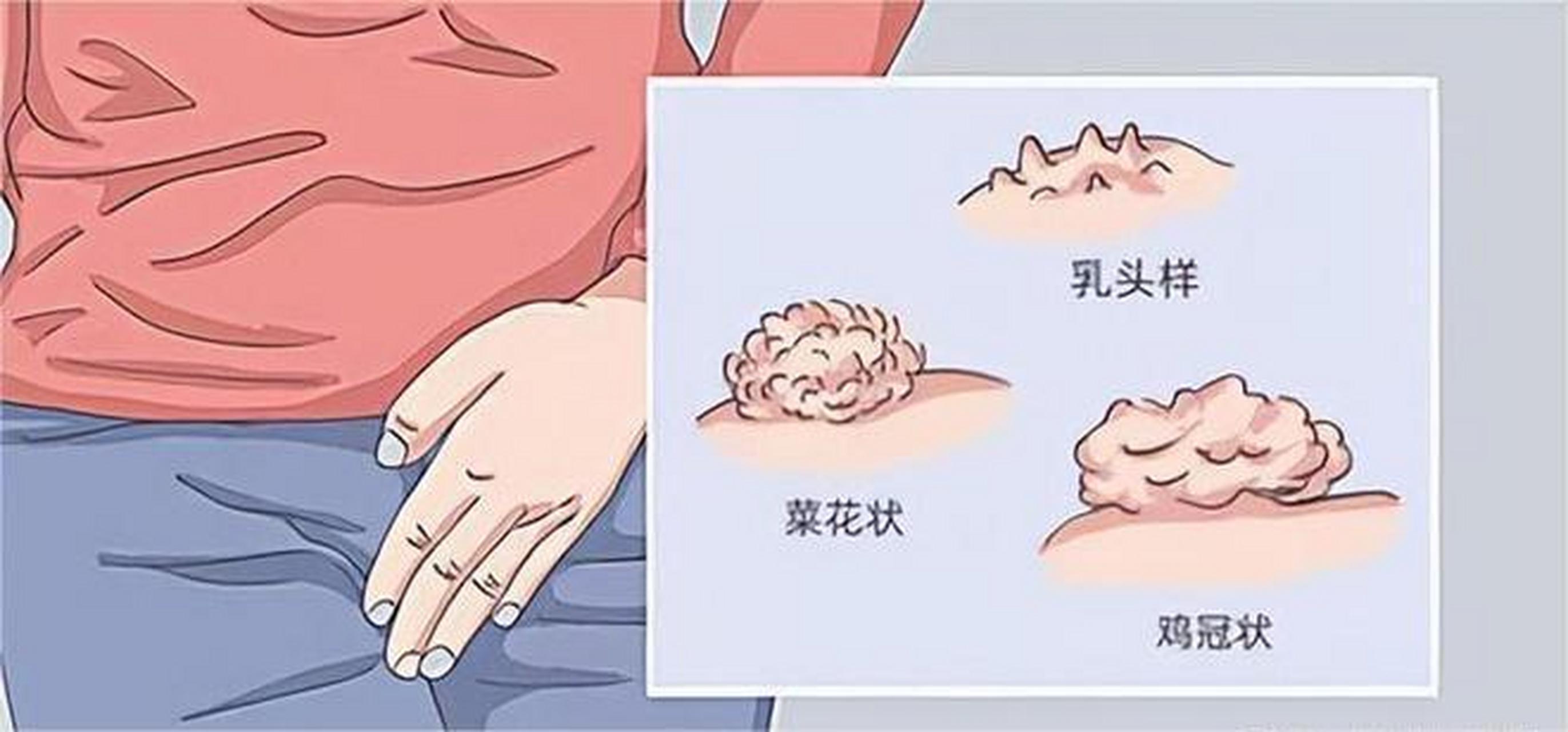 男性感染hpv,有这3种情况!