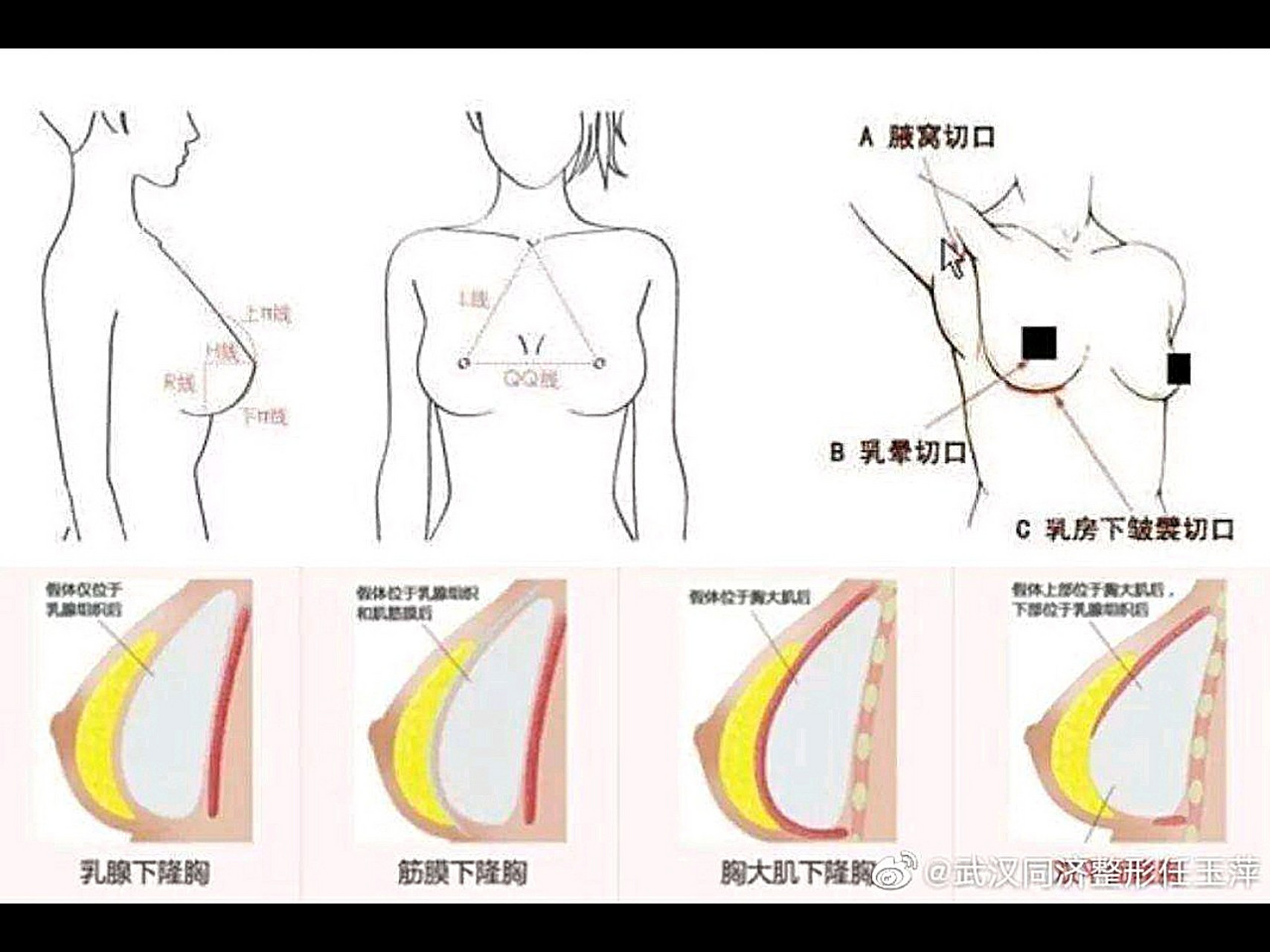 如何丰胸费用图片