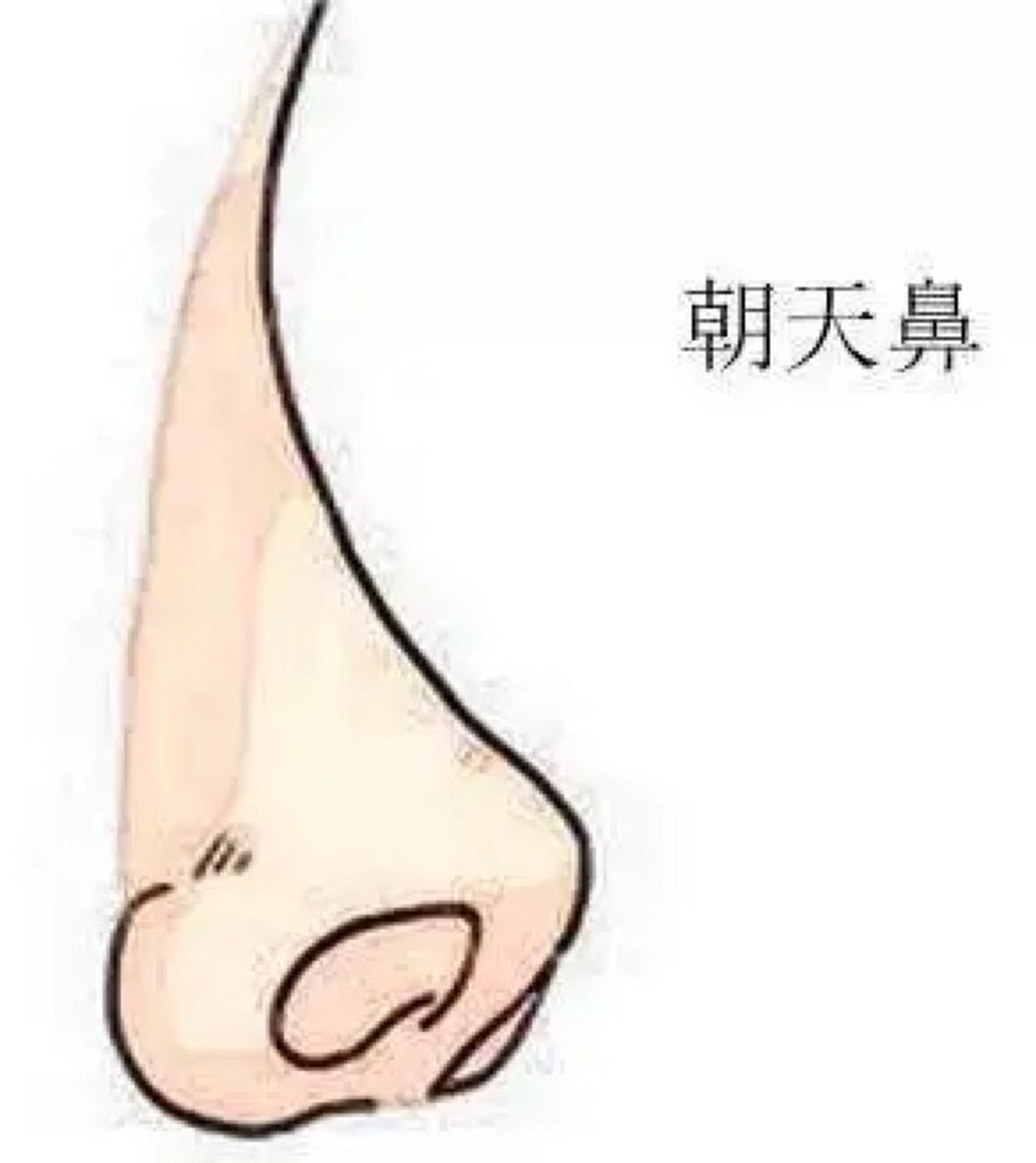 朝天鼻和正常鼻子的对比  朝天鼻是指鼻梁过度翘起,看起来像是朝天的