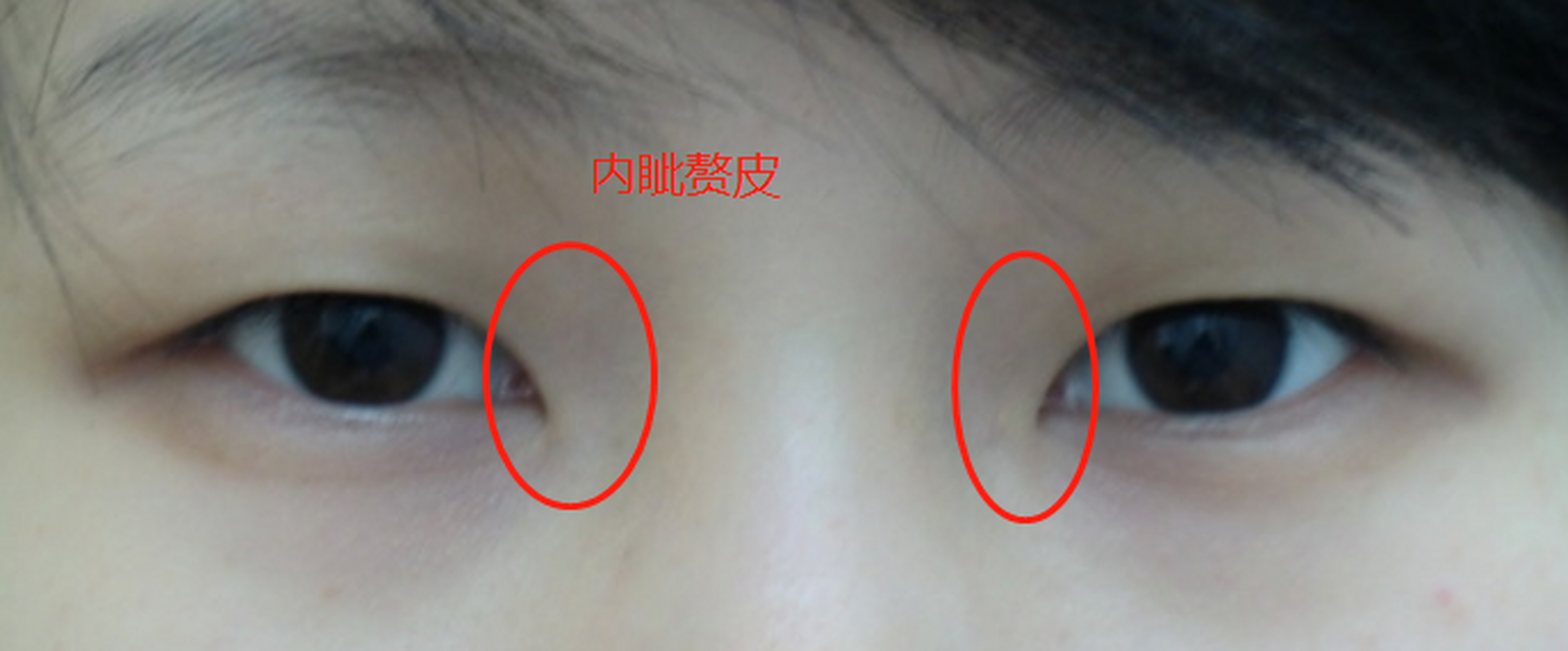 内眦赘皮也就是内眼角有自上而下的褶皱,轻者可能看起来会显得呆板