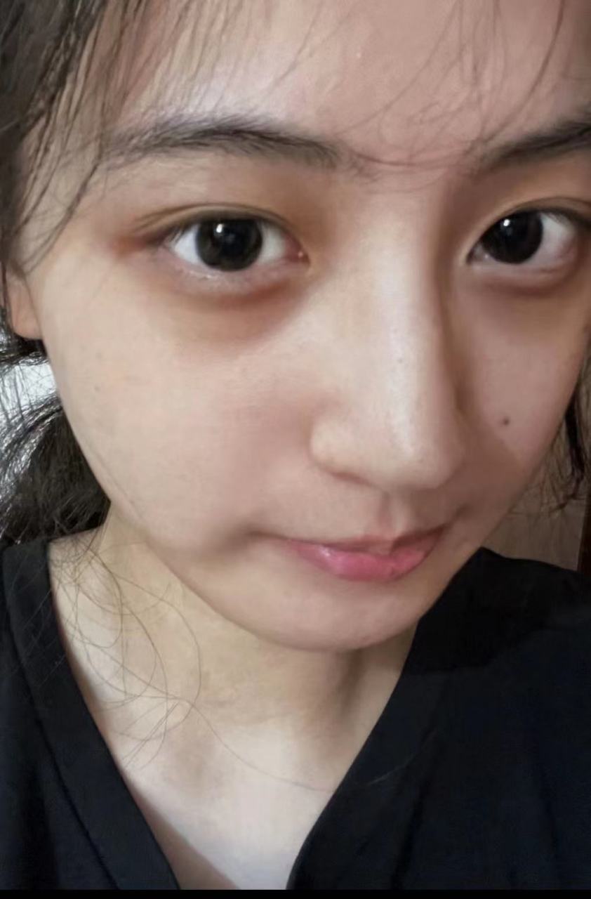 医美科普挑战赛#  血管型黑眼圈是由于眼部血管扩张,破裂或长期积累