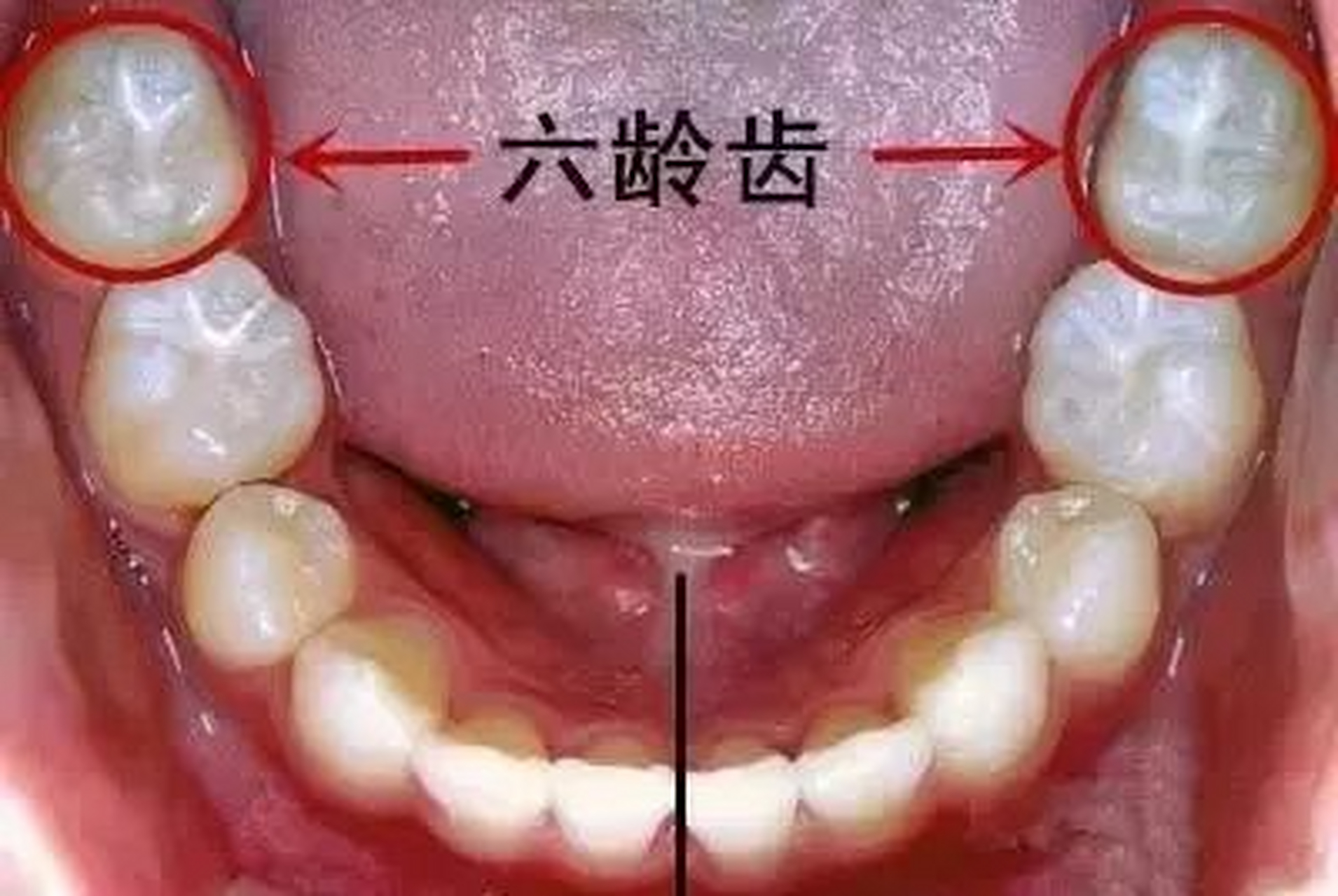 孩子长六龄齿图图片