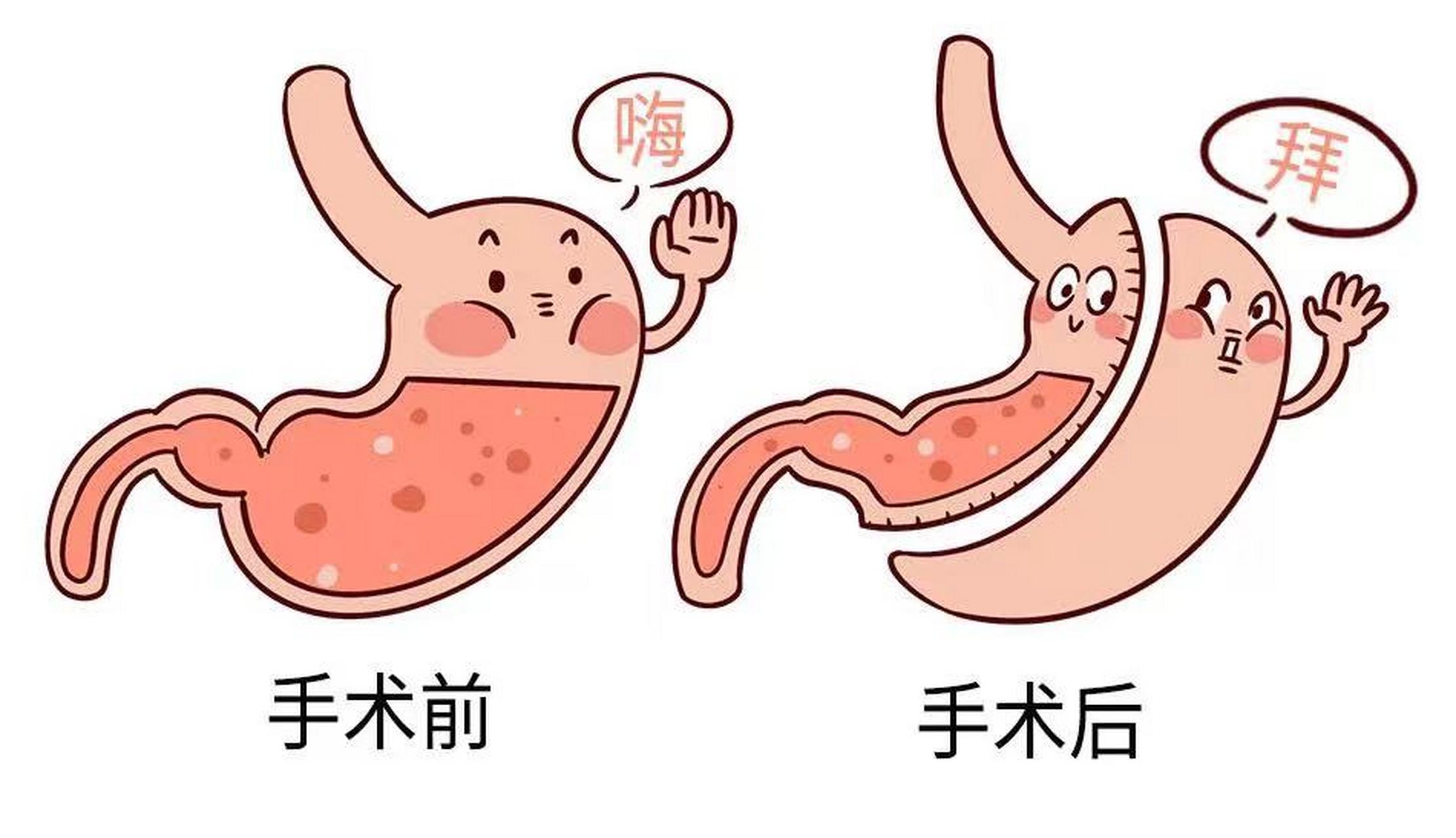 袖状胃切除术 这种手术操作简单,并发症少.