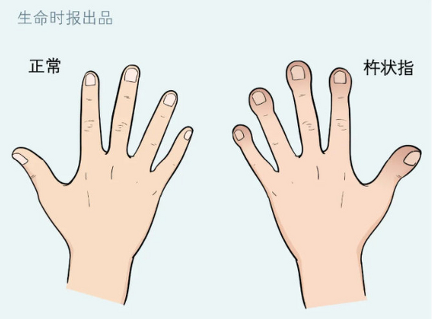 杵状指表现为手指或脚趾的第一节变得肥厚,呈杵状膨大,指甲