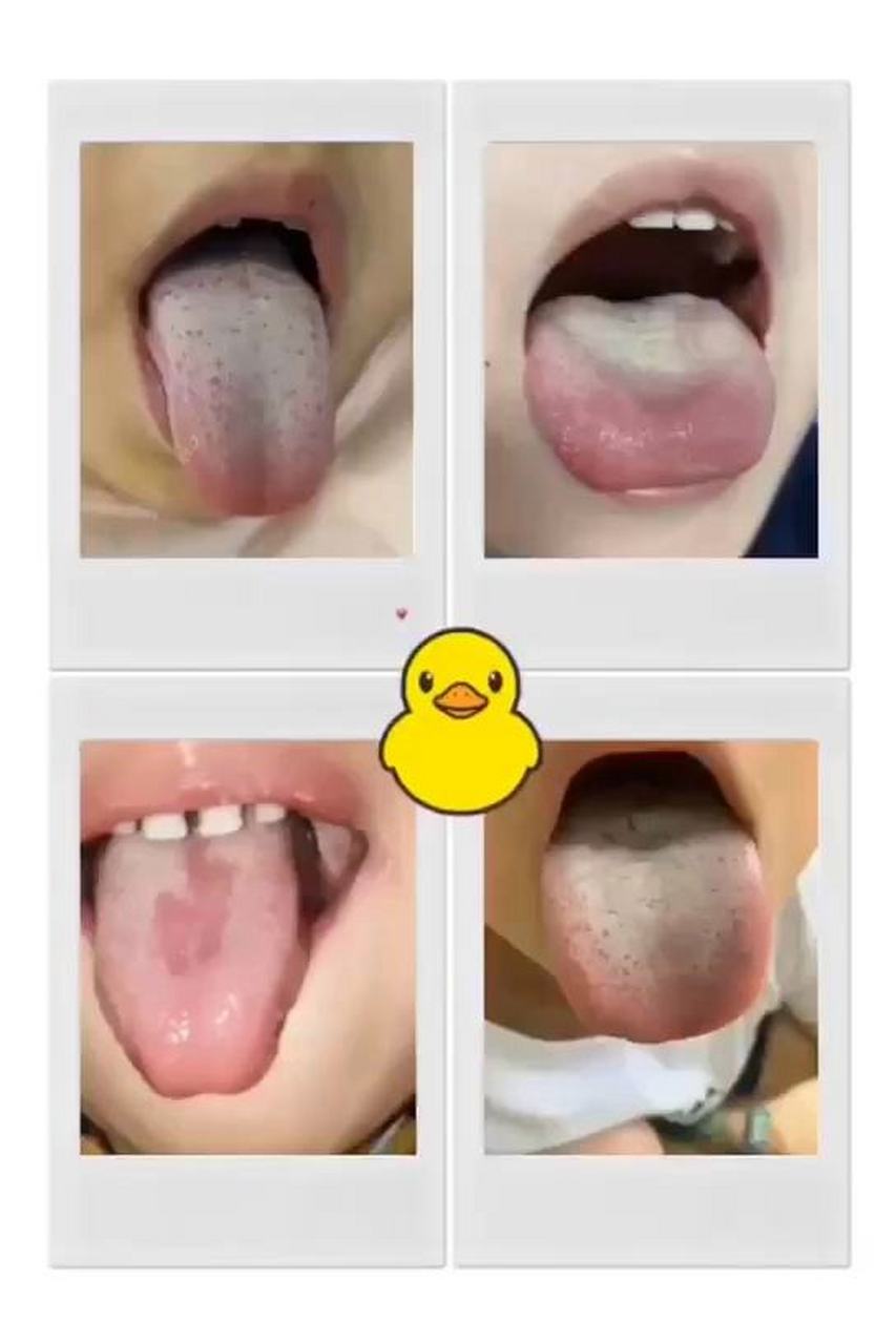 下面,我们就来具体了解一下这些舌苔类型和他们所可能代表的健康问题.