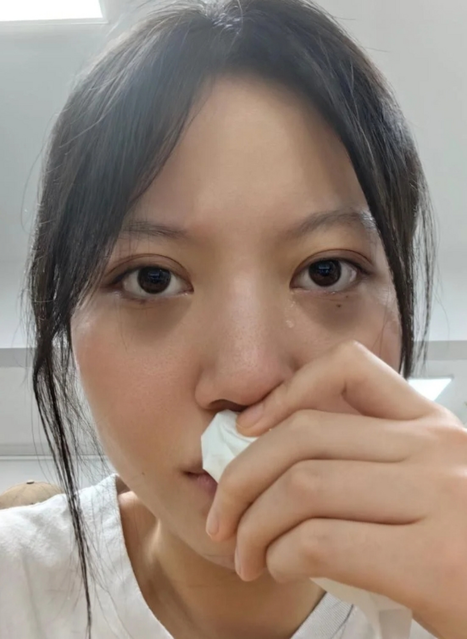 因此,治疗色素型黑眼圈的关键是减少黑色素的产生和促进黑色素的代谢.