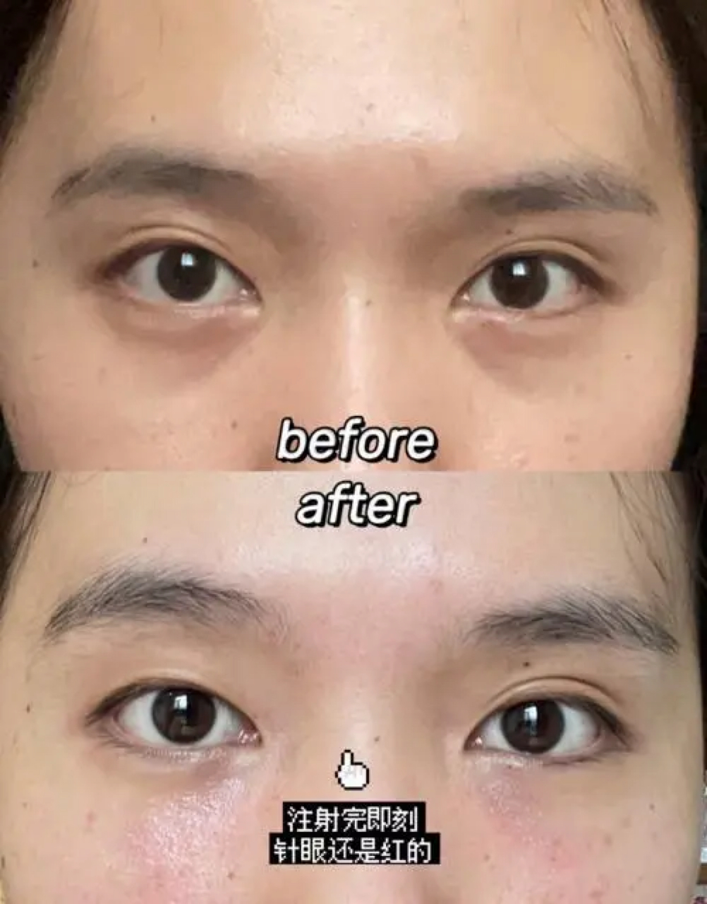 脸部泪沟凹陷怎么办?