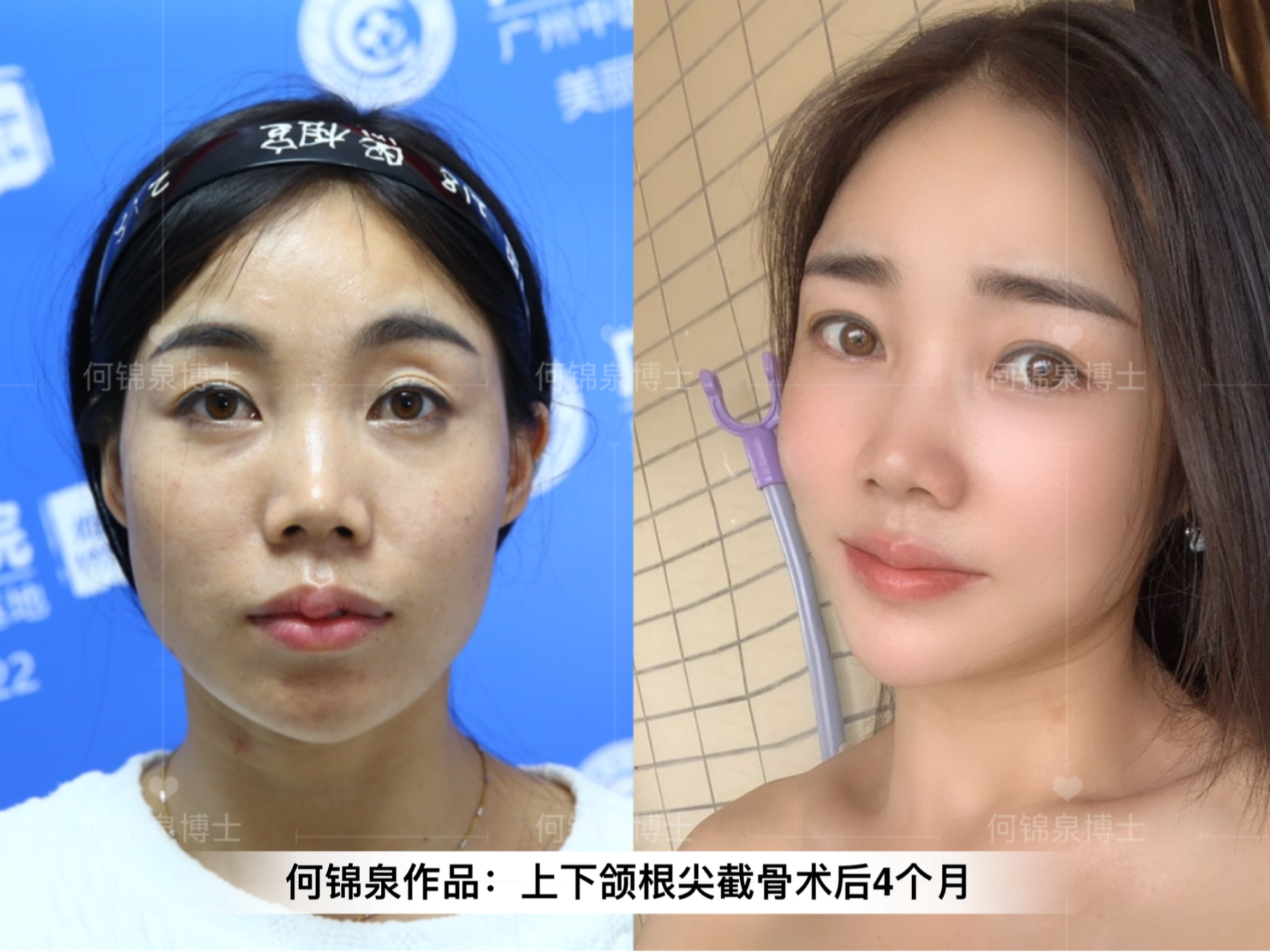 被嘲笑凸嘴,30岁女子靠正颌手术改变命运,终于迎来真爱!
