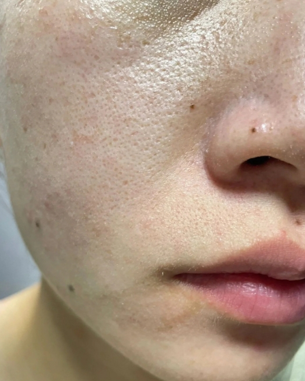 收缩毛孔是很多人关注的问题,因为扩张的毛孔会给肌肤带来瑕疵感.