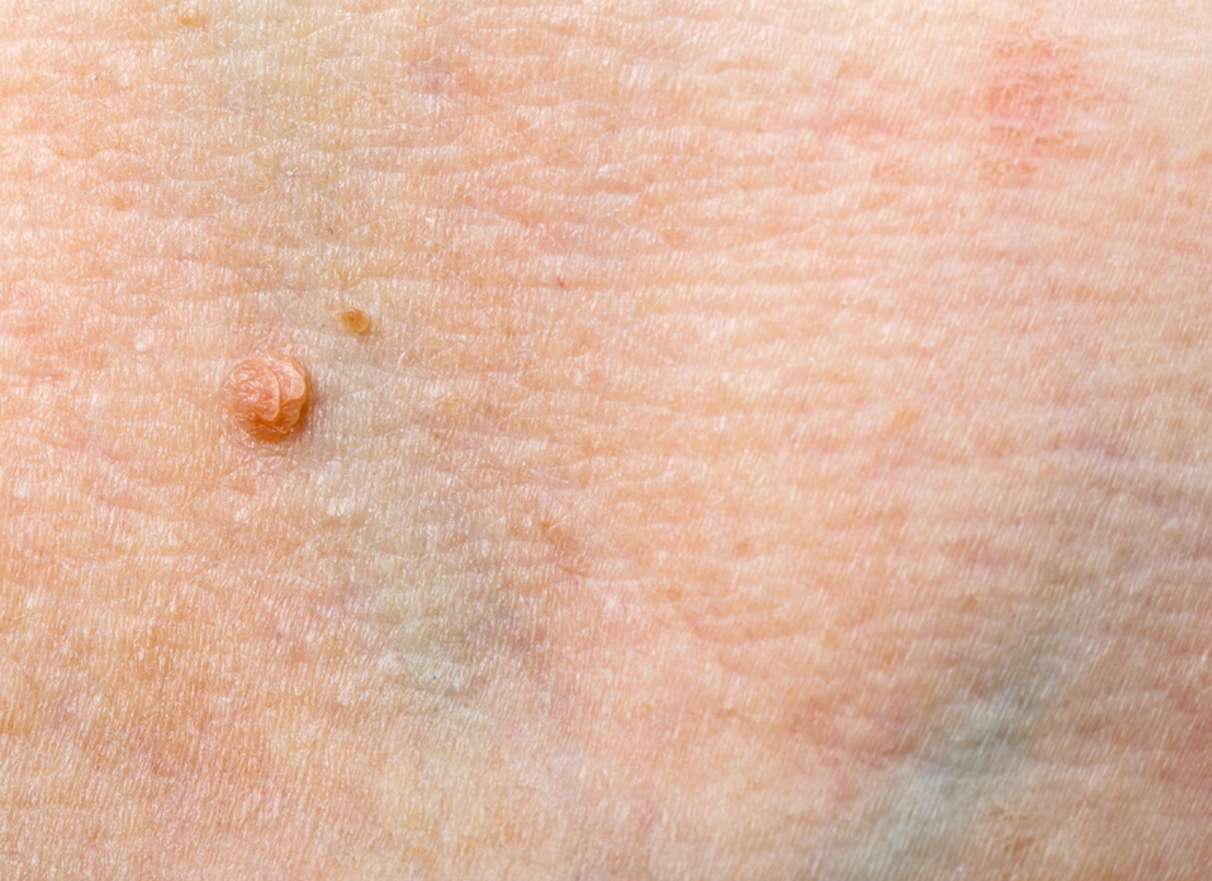 尖锐湿疣治好后需要注意什么?  其实即使疣体已经消失,仍需要对身体进