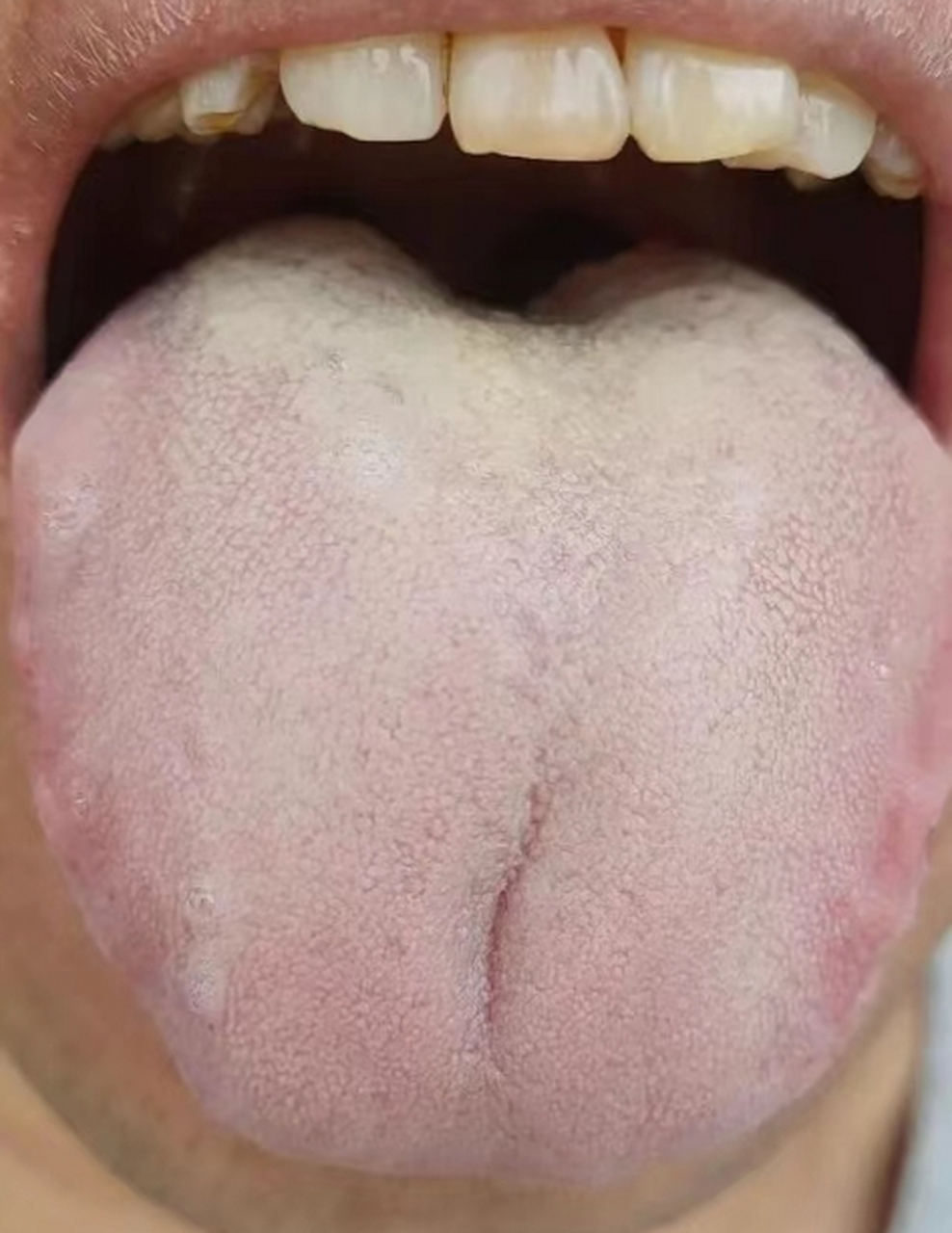 肾阳虚 时 短,有湿热 挺不坚,脾肾两虚这样调!