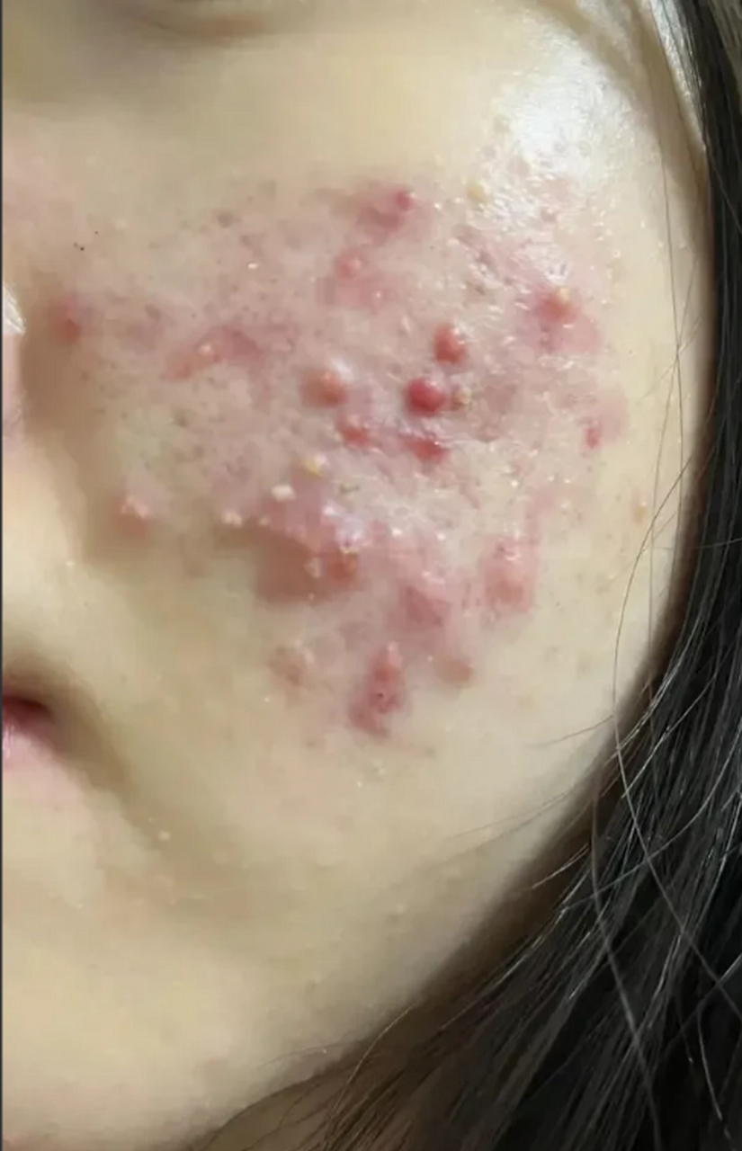 比如:丘疹,脓疱,囊肿  94这种已经属于重度痤疮了,简单外用很难解决