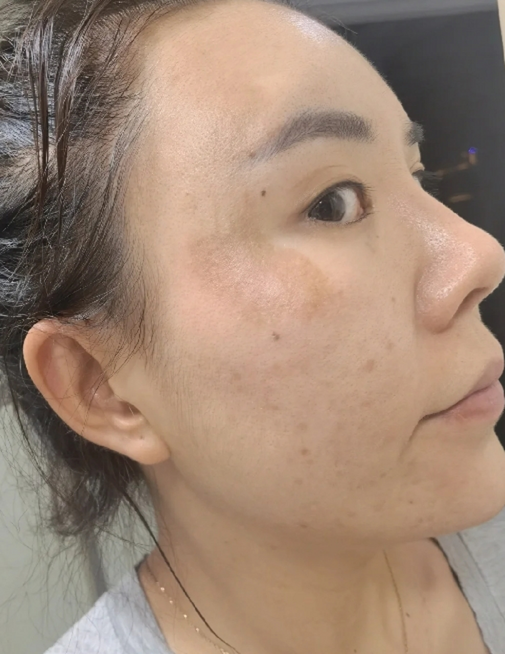 脸上的黑色素沉着问题困扰着很多人,而去除黑色素是许多人希望实现的