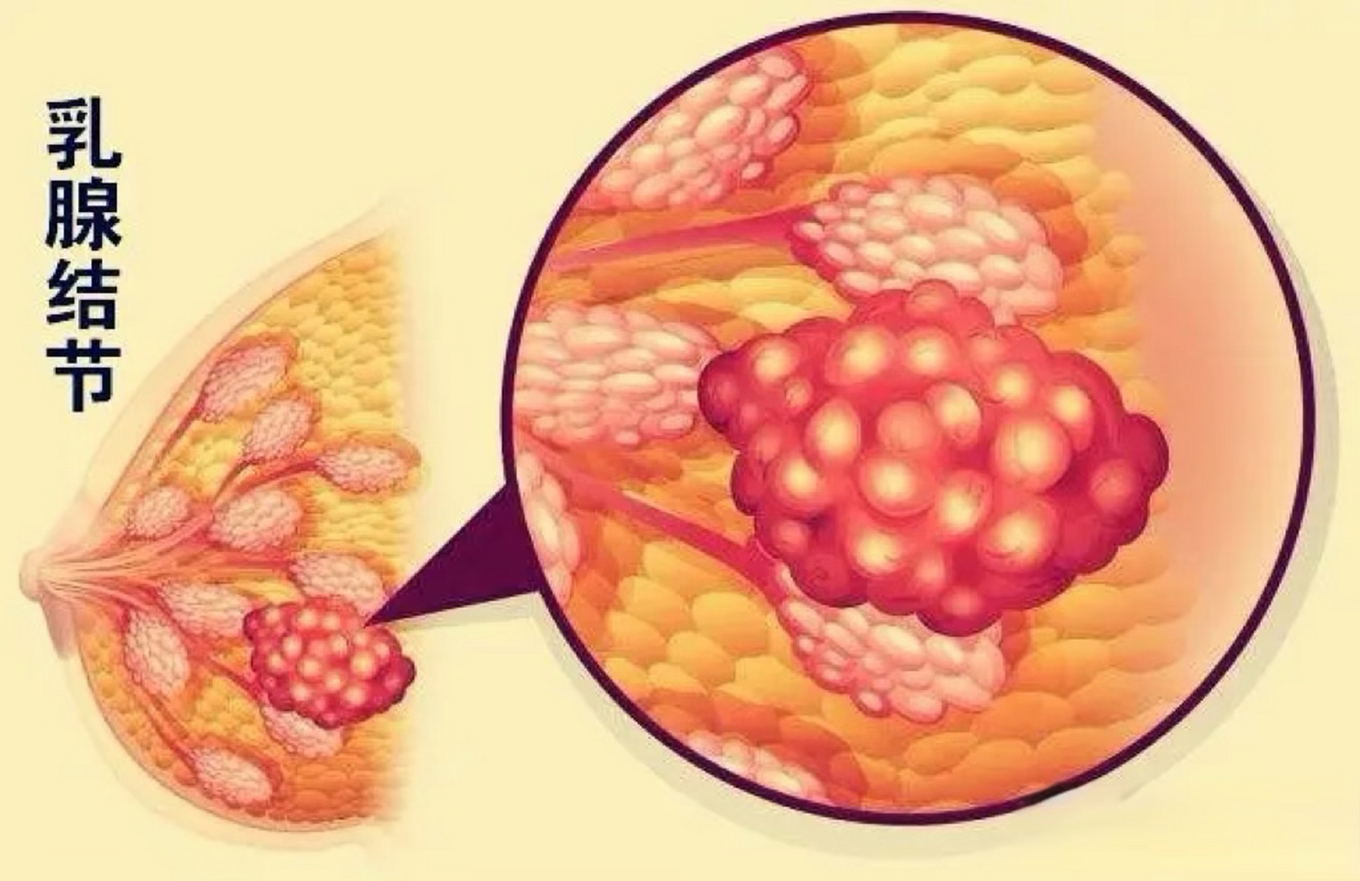 乳腺增生图鉴图片
