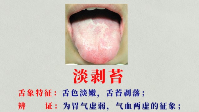 今天我们学会认识四种不同的剥落苔,舌苔是胃气所化,为啥会出现舌苔