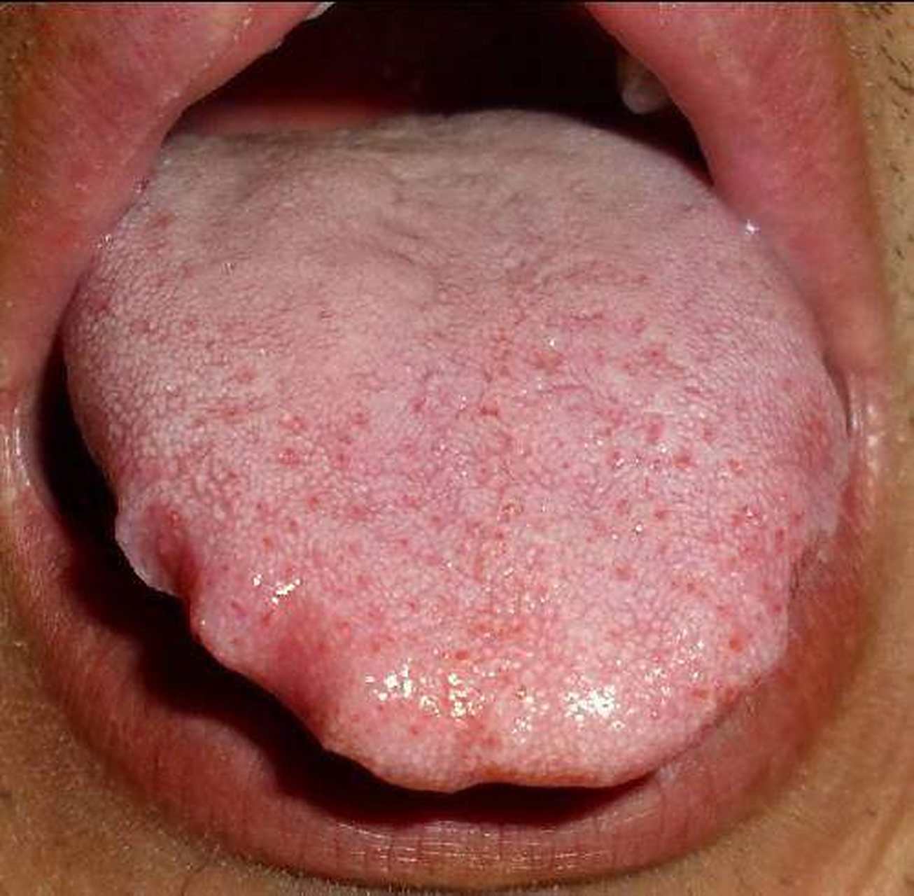 舌体胖大有齿痕,可能是什么原因导致的? 1.