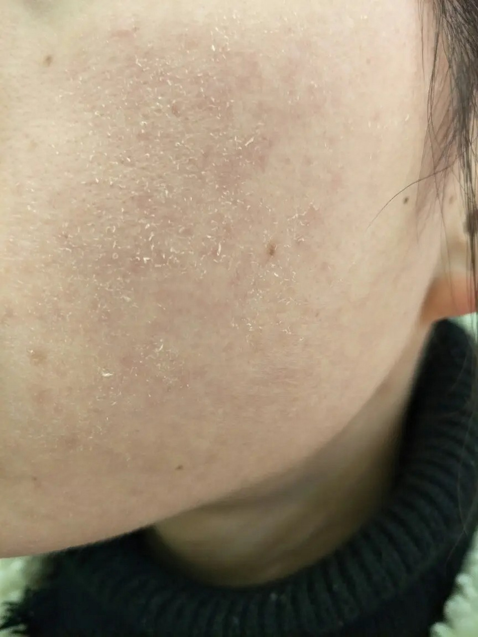 脸上皮肤起皮干燥有碎屑怎么办?