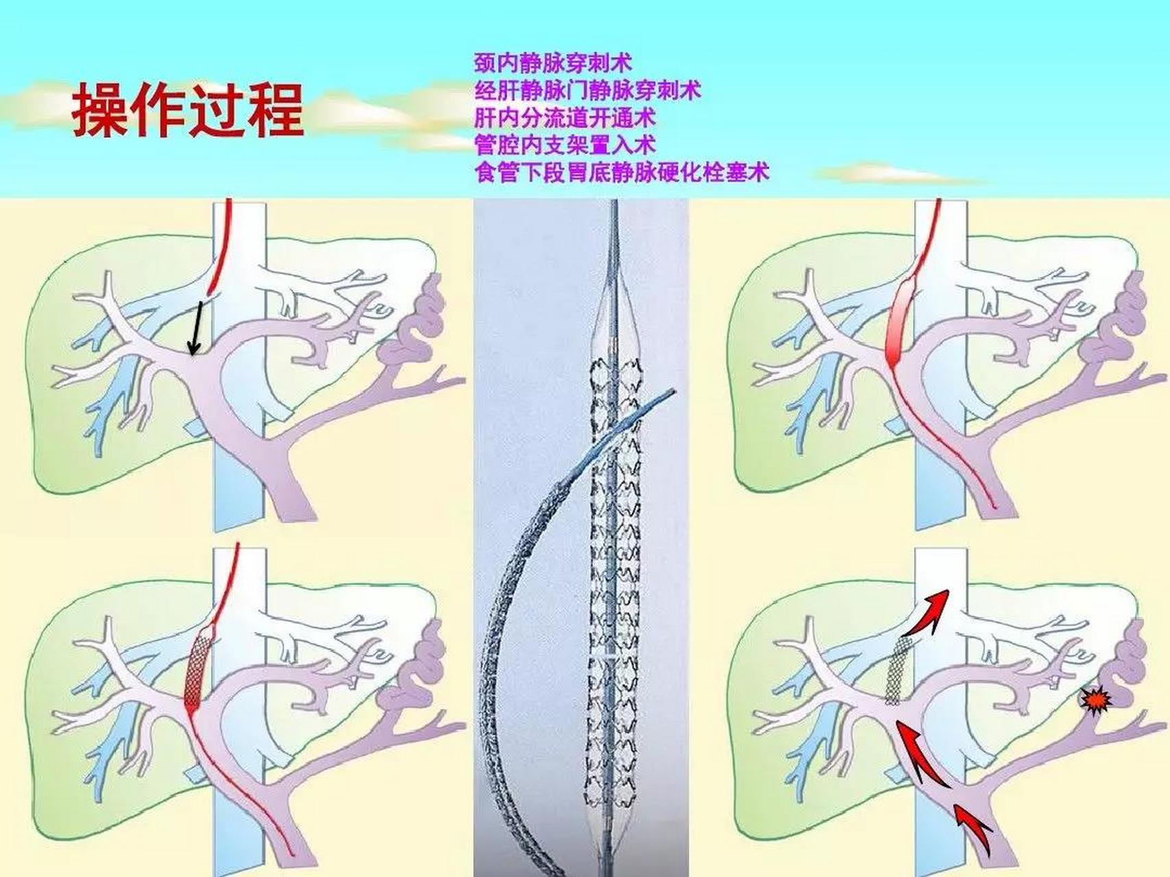 蛛网膜囊肿分流术图片图片