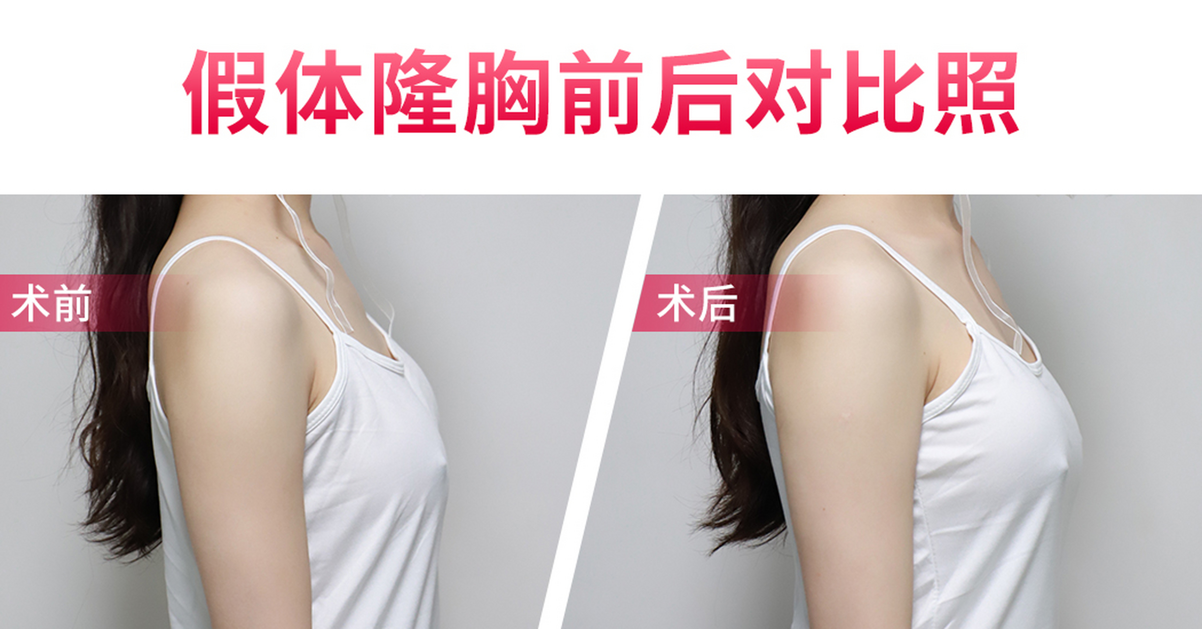 假体隆胸# 分享一则假体隆胸案例,美女术前是平胸,不想要太大的尺寸