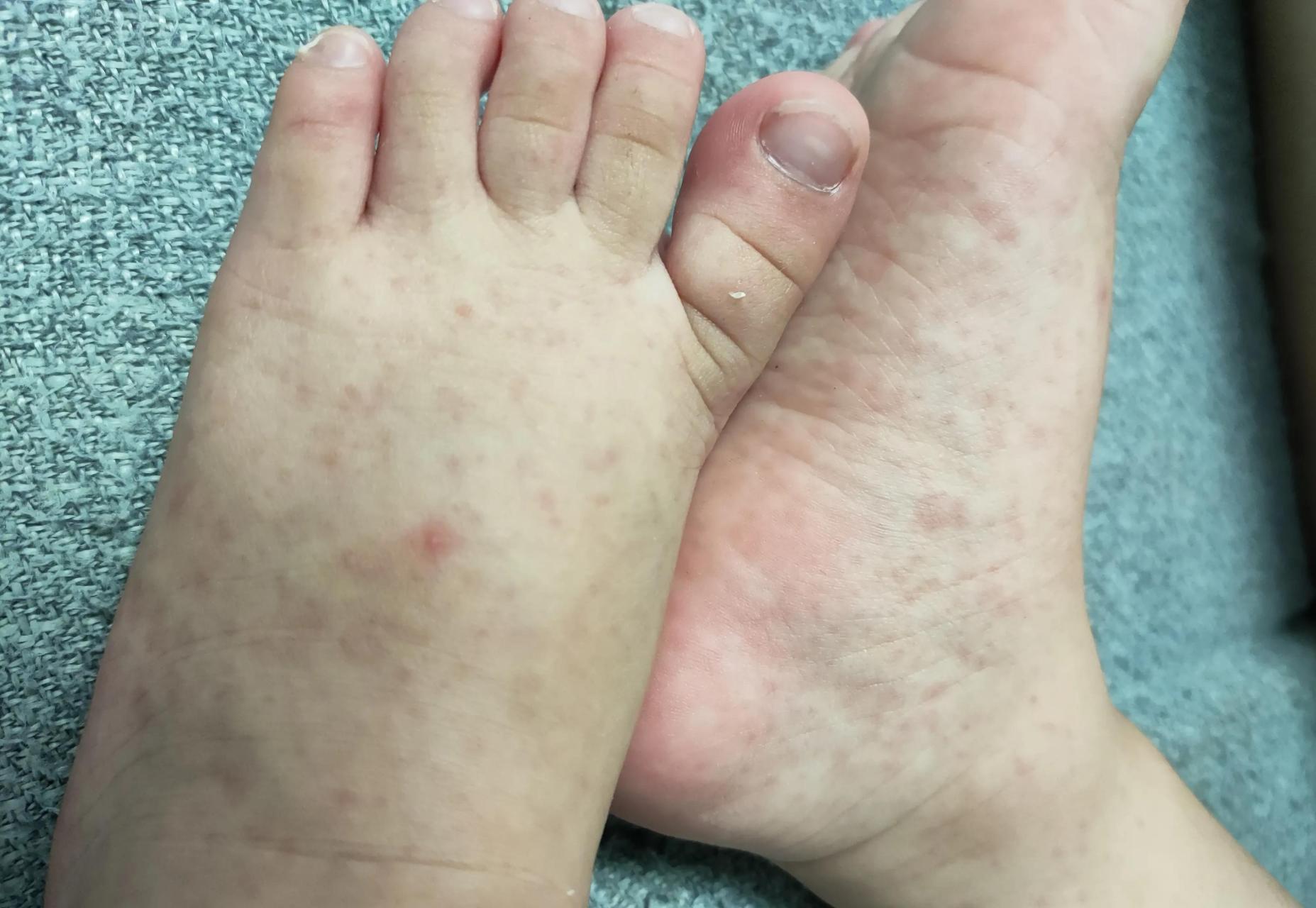 宝宝这个脚是怎么了?