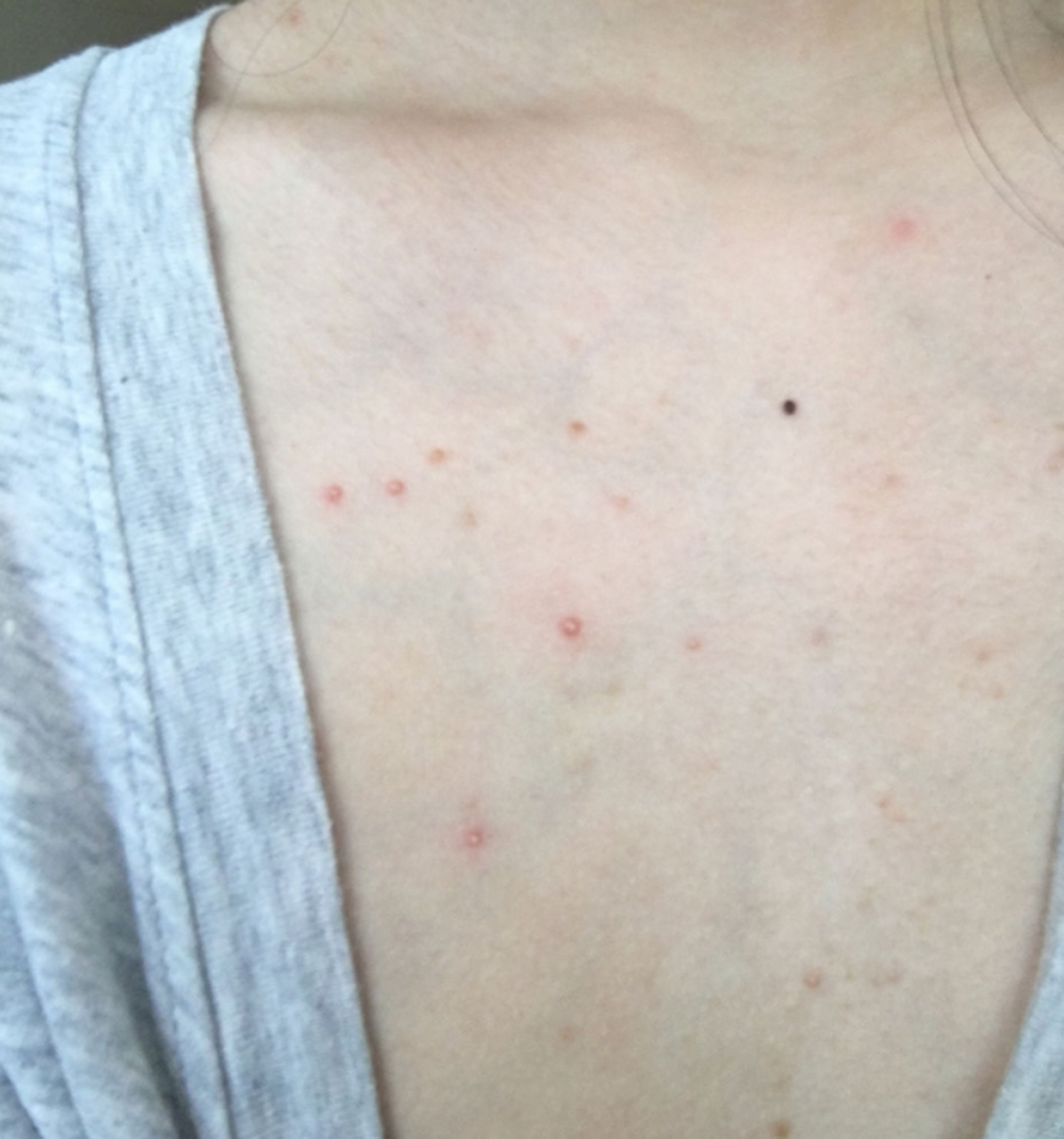 胸前长痘痘怎么办?   首先,要保持胸部区域的清洁,避免污染和感染.