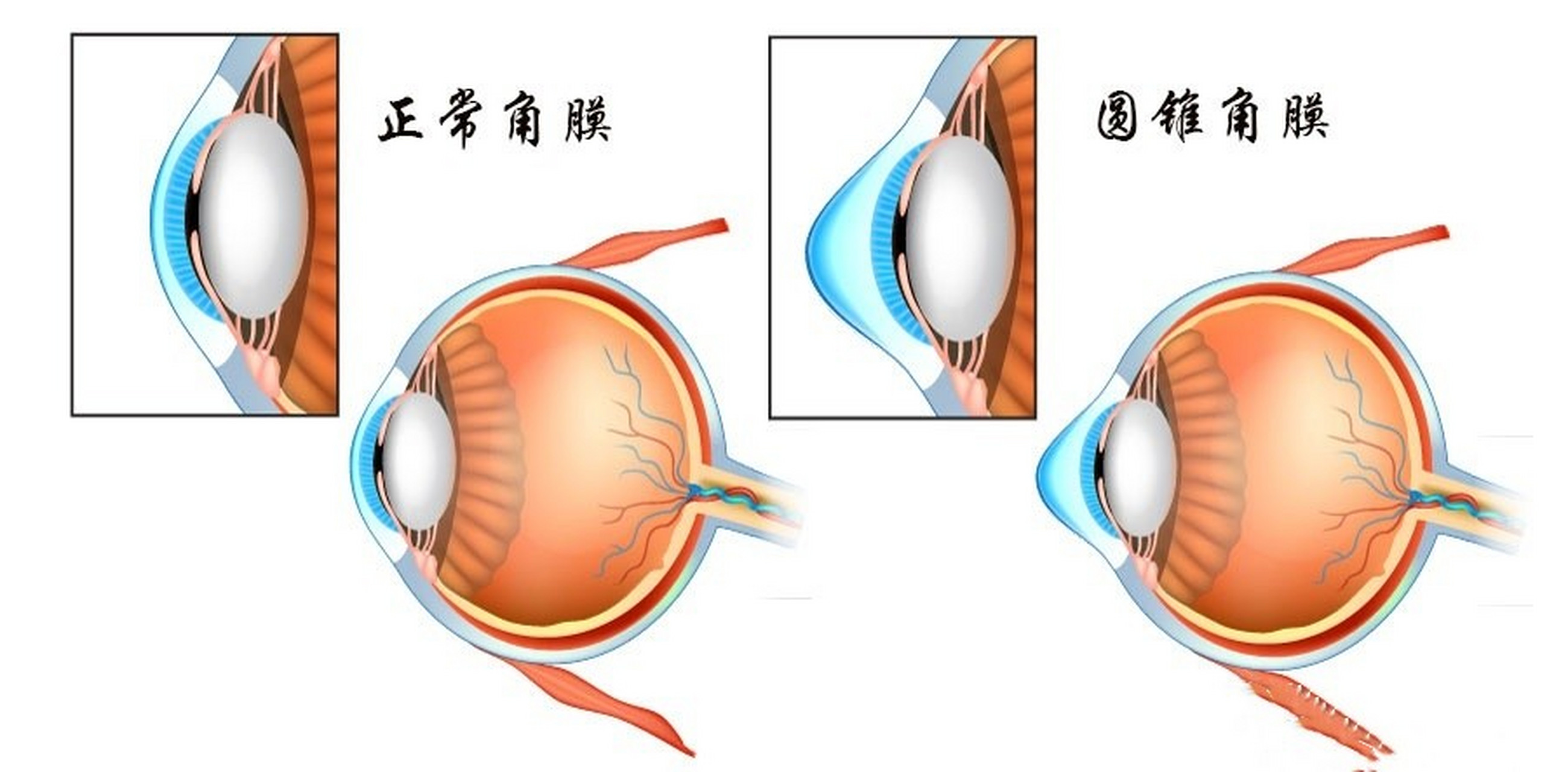 有人在知乎上问,近视手术会导致圆锥角膜吗?