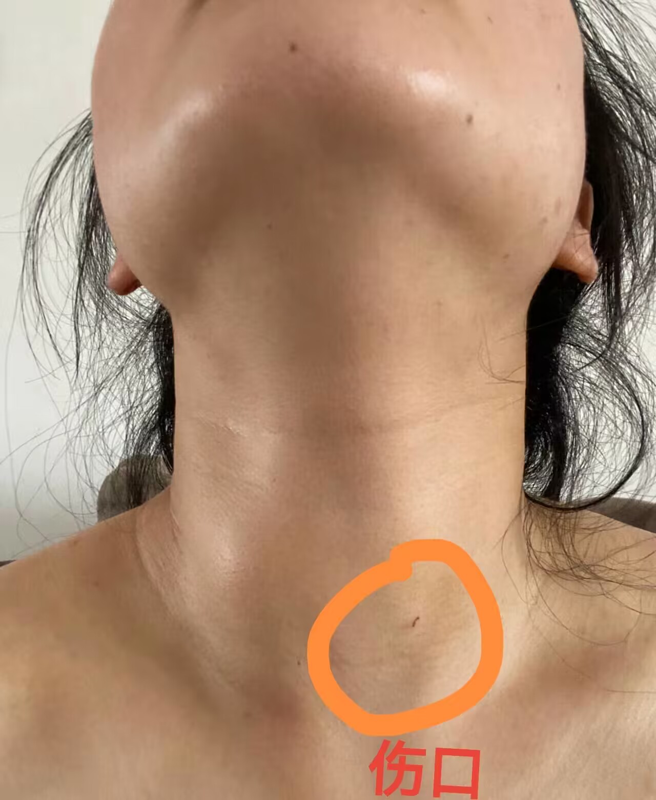 甲状脖子粗是甲亢还是甲状腺结节甲状腺结节的4