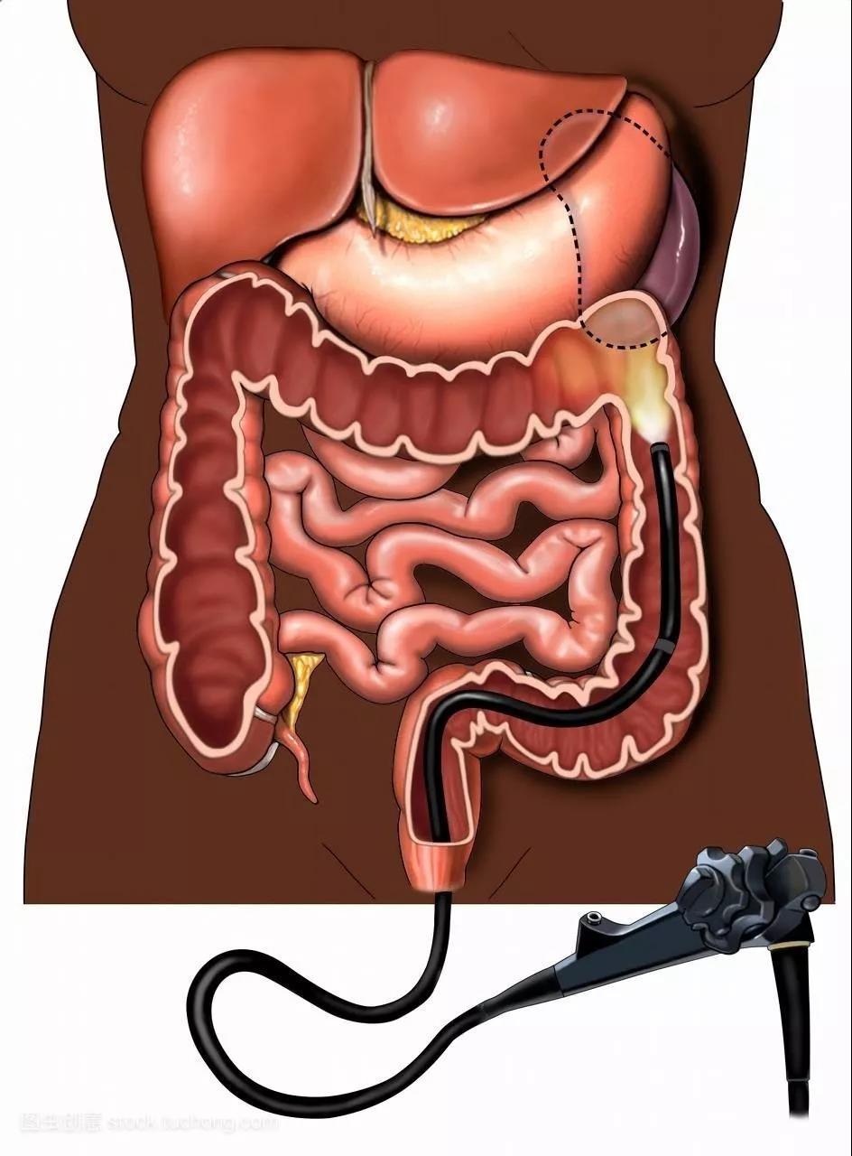 做一次肠镜真能管5年?