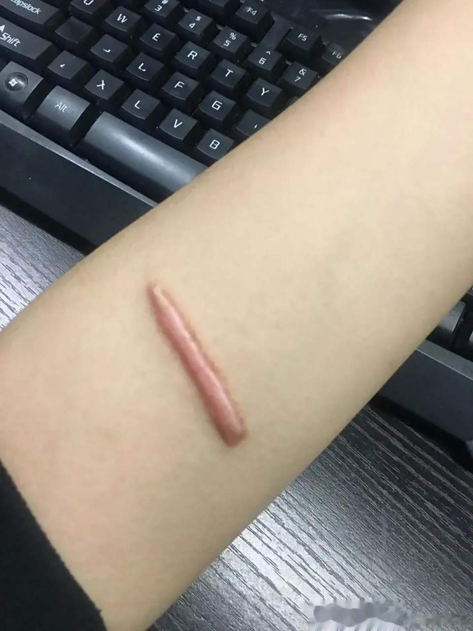 网友:疤痕体质,胳膊上有道疤痕很难看,一直想不到用什么方法遮盖,去了