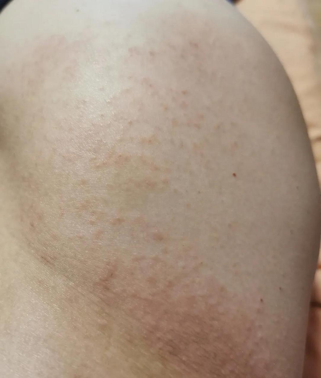这些红疙瘩,痒痒的,先是脖子然后扩散到四肢,去了东方医院,皮肤病医院