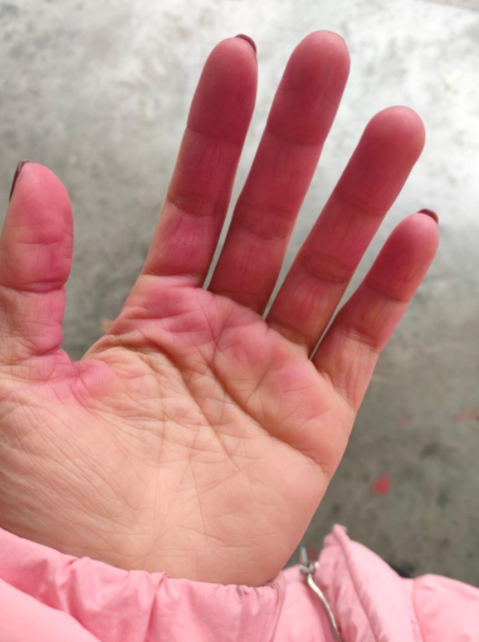 网友:这个红色的胎记跟了我有20多年了,有没有什么办法能去掉呀?