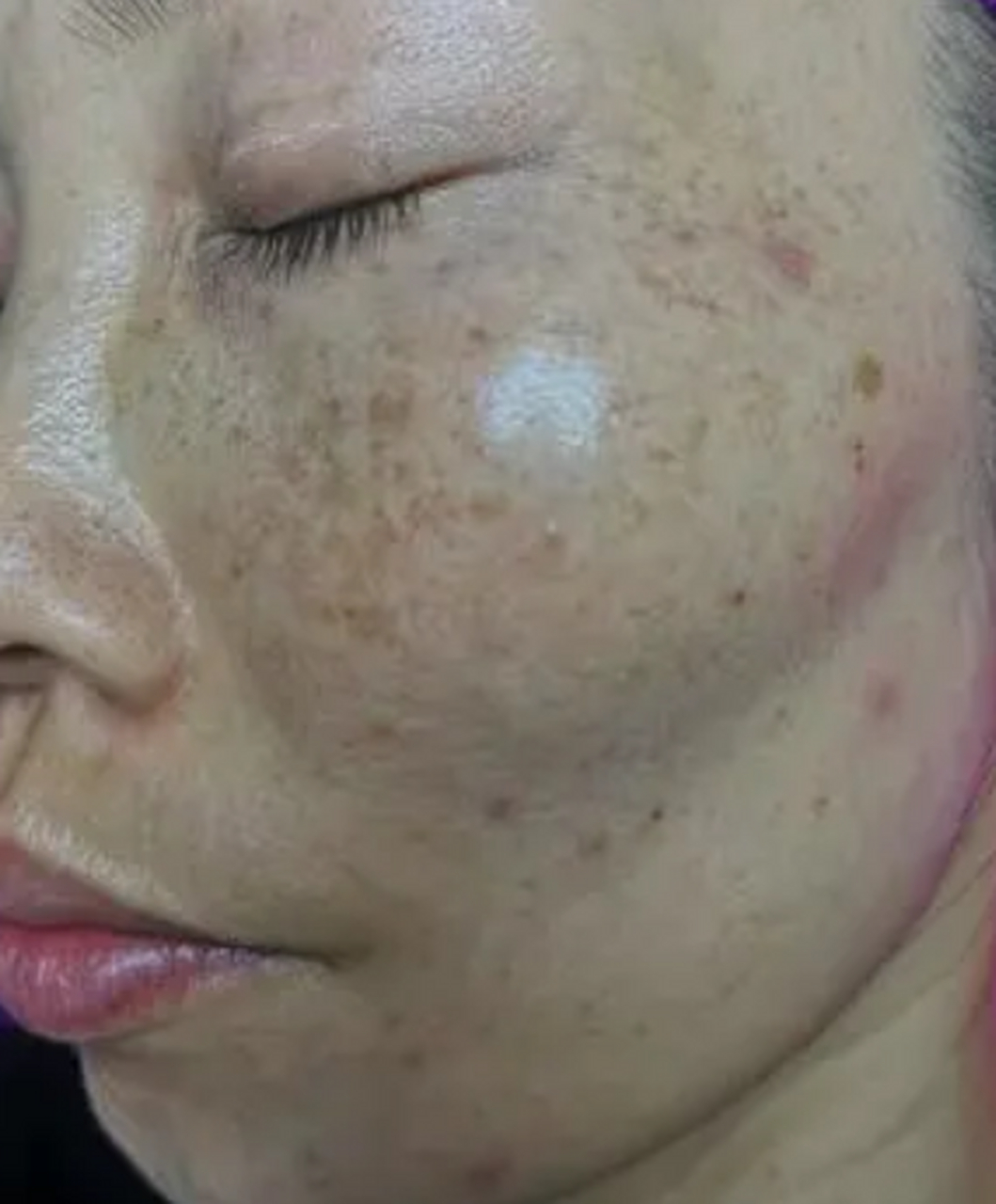 的发青色,中医讲青色属木,属肝,典型特点:脾气急噪,这个病虽然在脸上