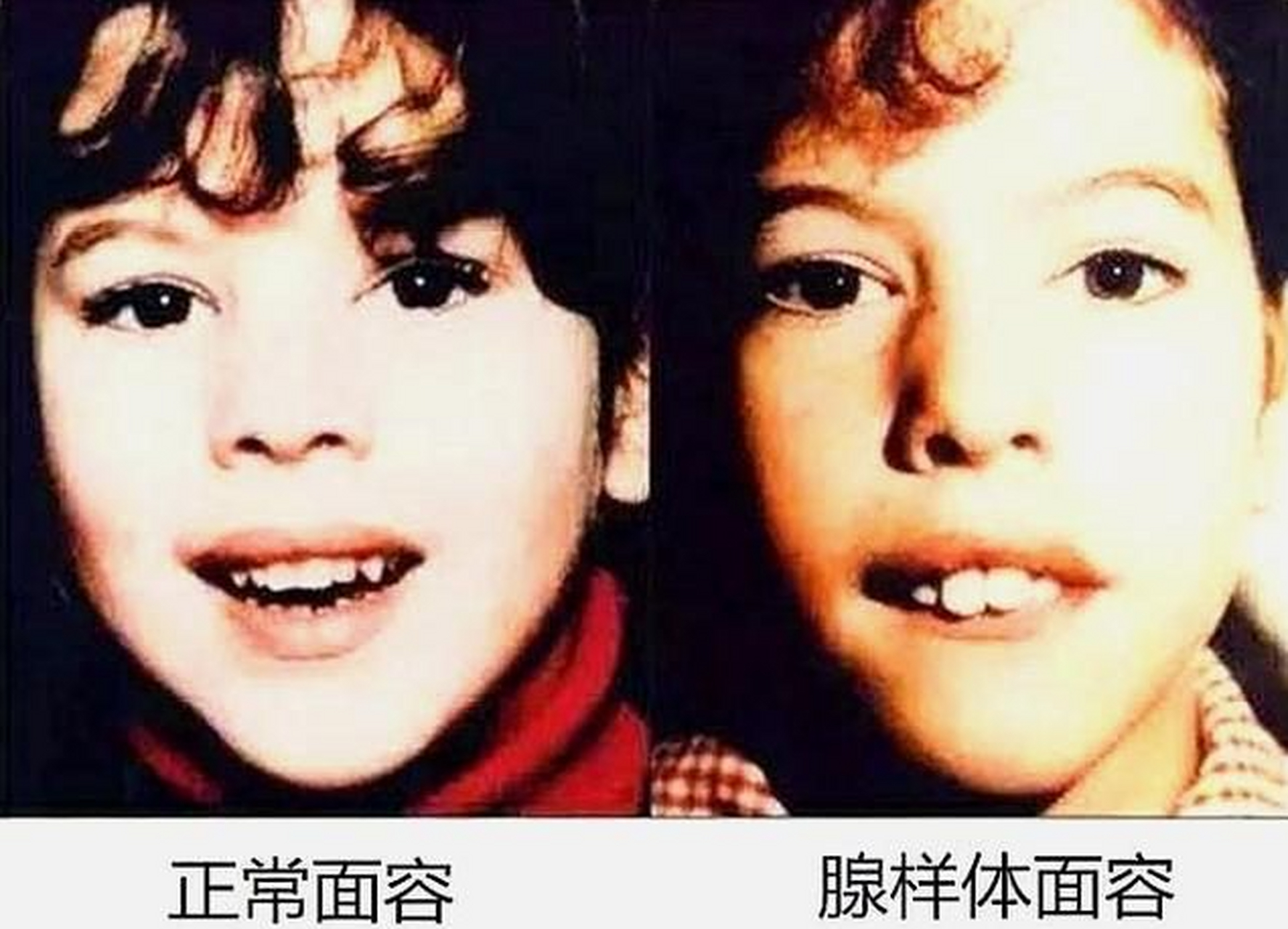 腺样体肥大的儿童,记住3原则,6-7月份不再大 一,饮食原则: 不吃不碰