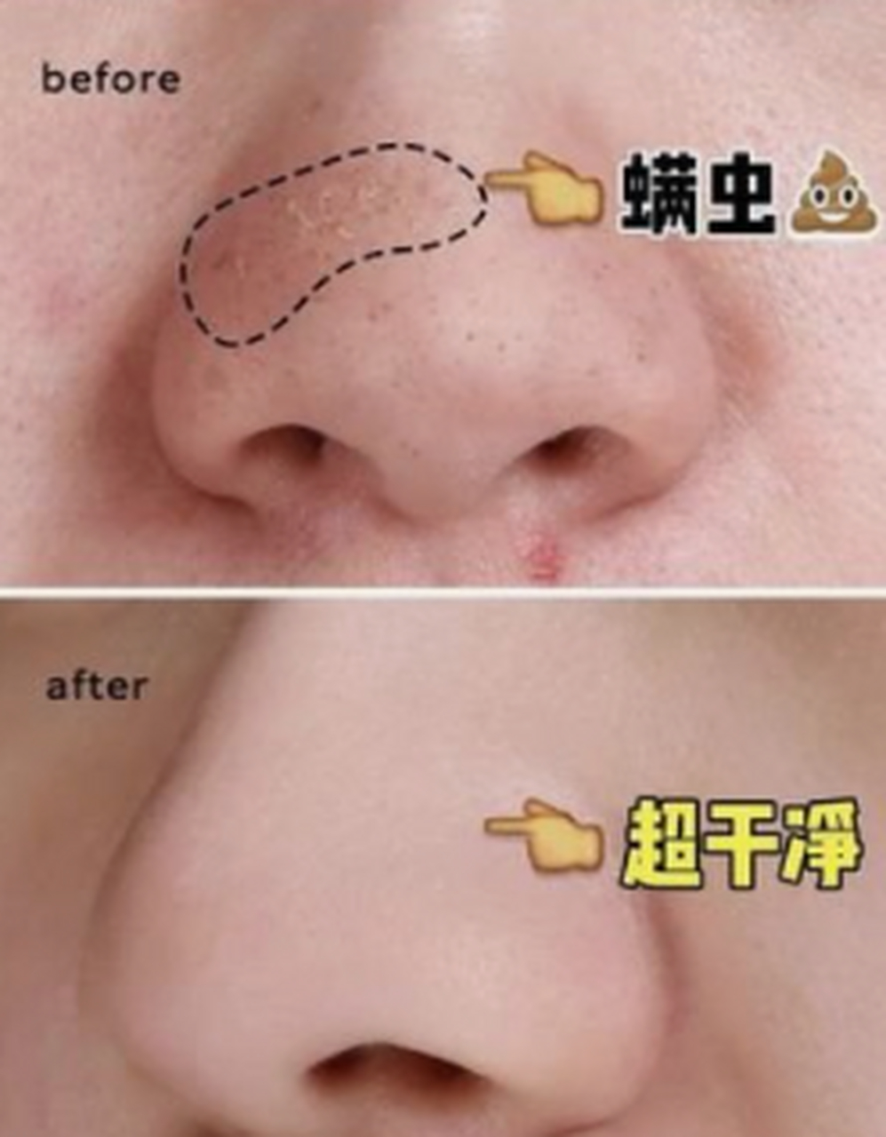 外表不同 螨虫痘:外表不会很红,且面积一般比痘痘小一号,边界模糊