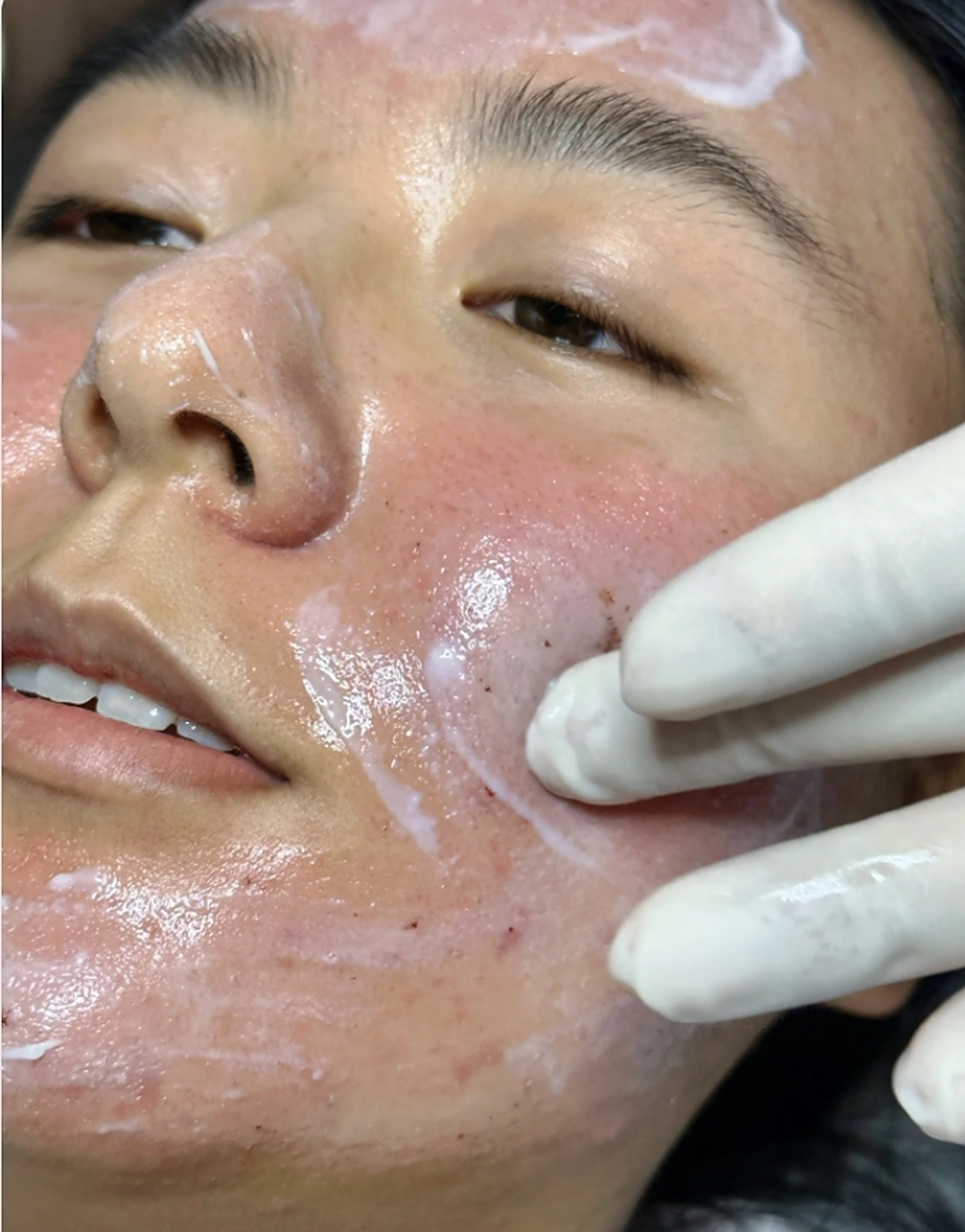 脸上刷酸有什么好处 #医美科普挑战赛#  近年来,越来越多的人开始关注