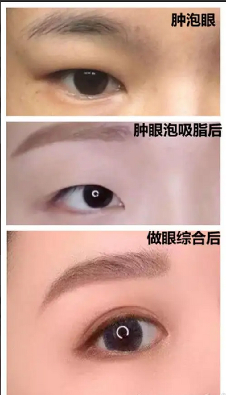 肿眼泡可以只抽脂不割双眼皮吗?