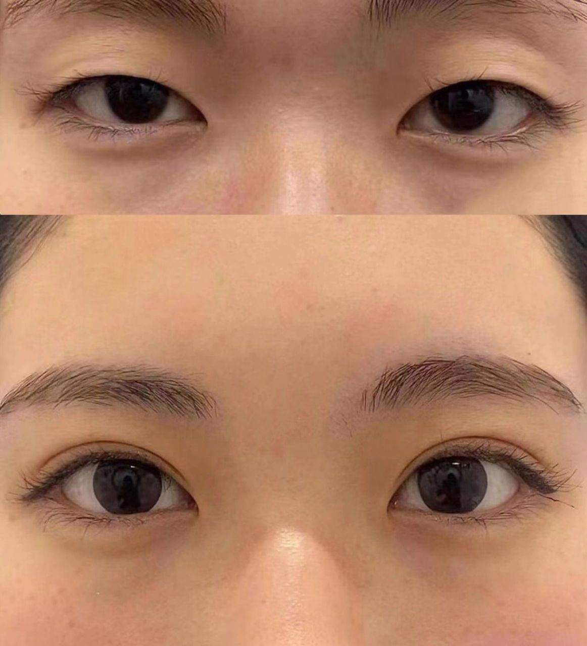 没想到做了双眼皮以后,眼窝凹陷的问题也得到了改善,感觉自己都变年轻