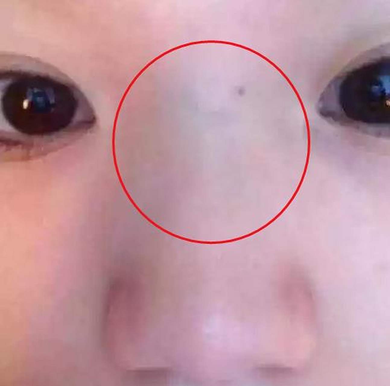 宝宝鼻梁有青筋,3种疾病躲不掉!