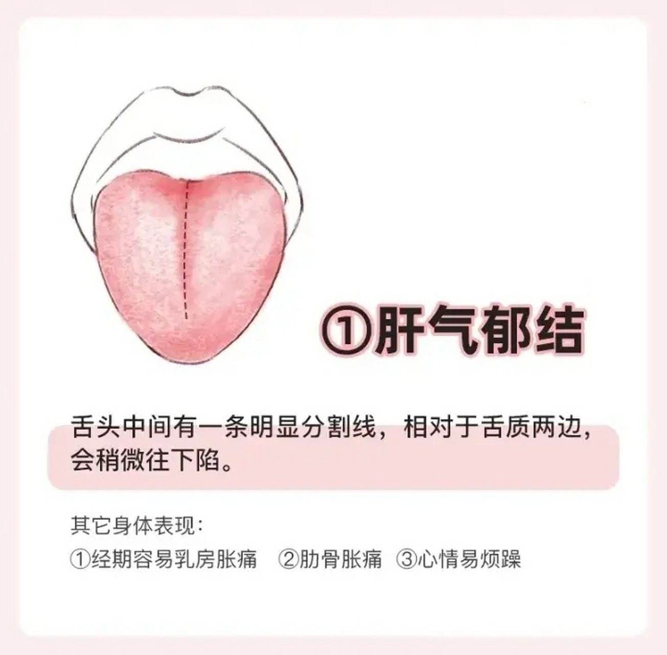 辨舌知健康 1,肝气郁结舌象 2,心火旺舌象 3,肝火旺舌象 4,肝血虚舌象