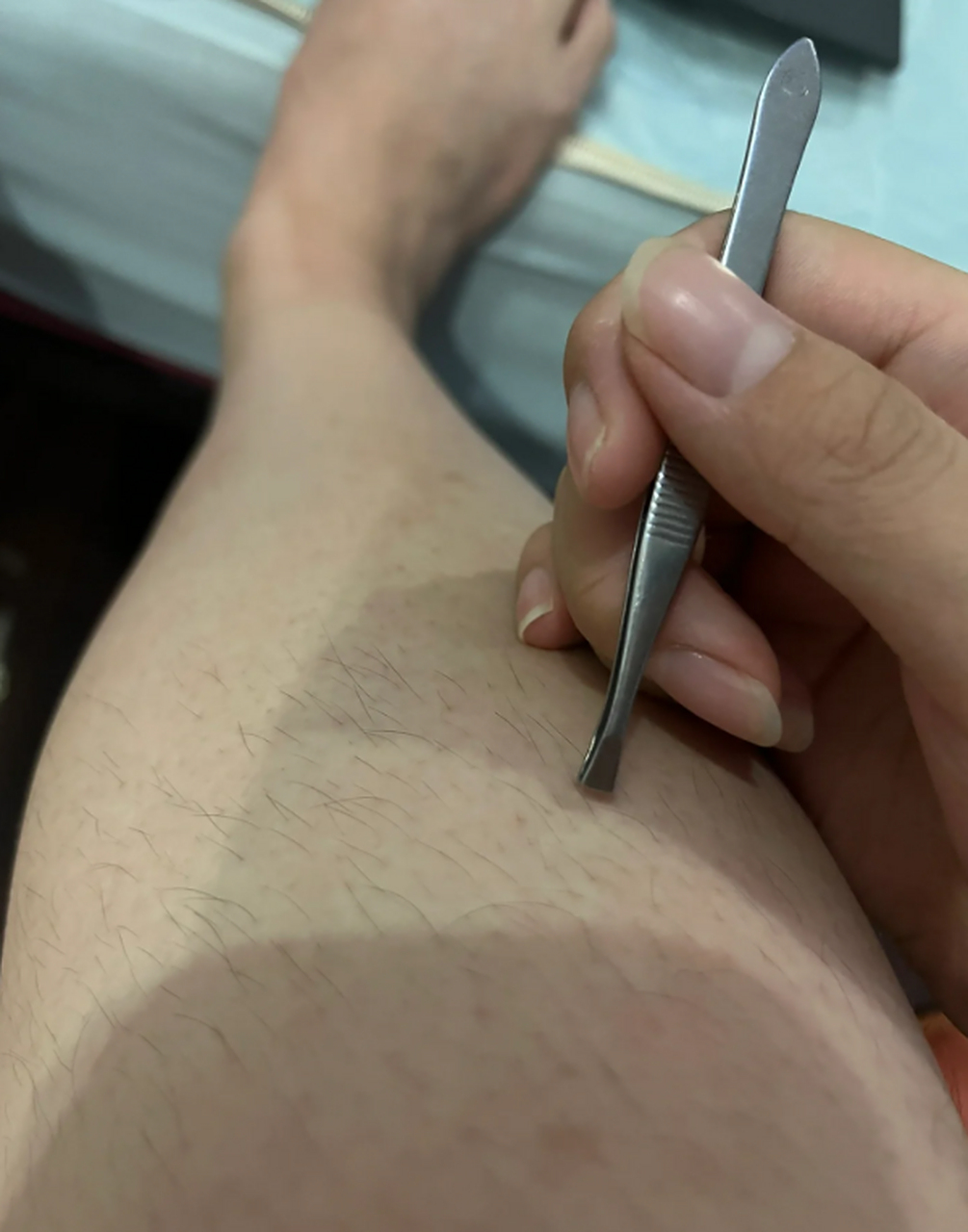 腿上汗毛怎么永久去除?