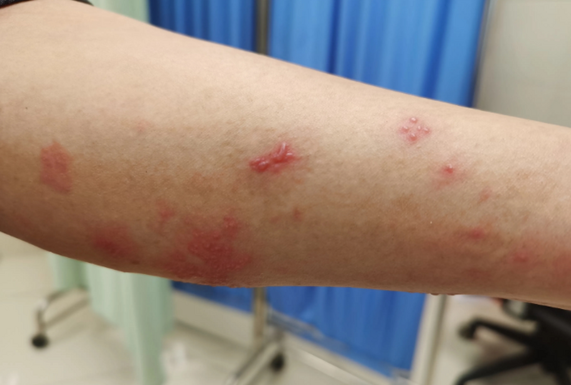 "  #学问分享官# 虽然,带状疱疹确实是长