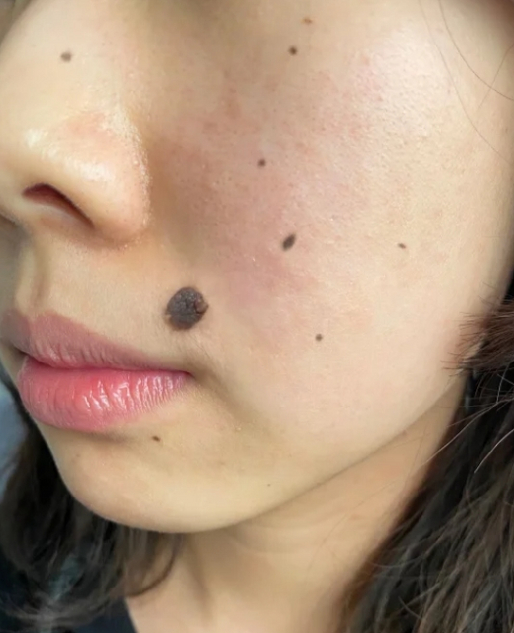 鱼鳞痣怎么去除?