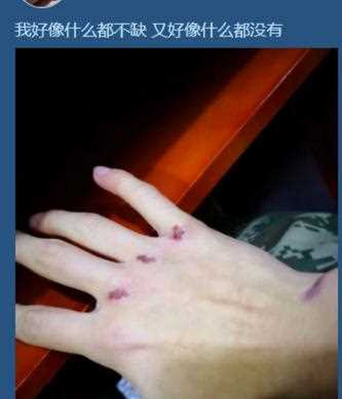 在儿子qq空间里看到儿子手受伤了,都不敢过问,害怕儿子知道了关闭了