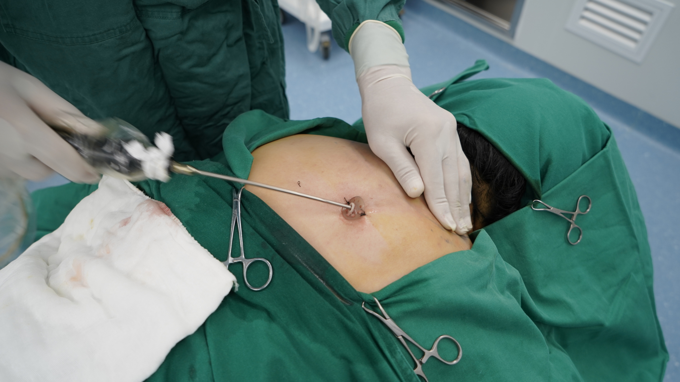 这里我回答一下: 普通的负压吸脂是通过小切口,反复刮搔后吸出富贵包