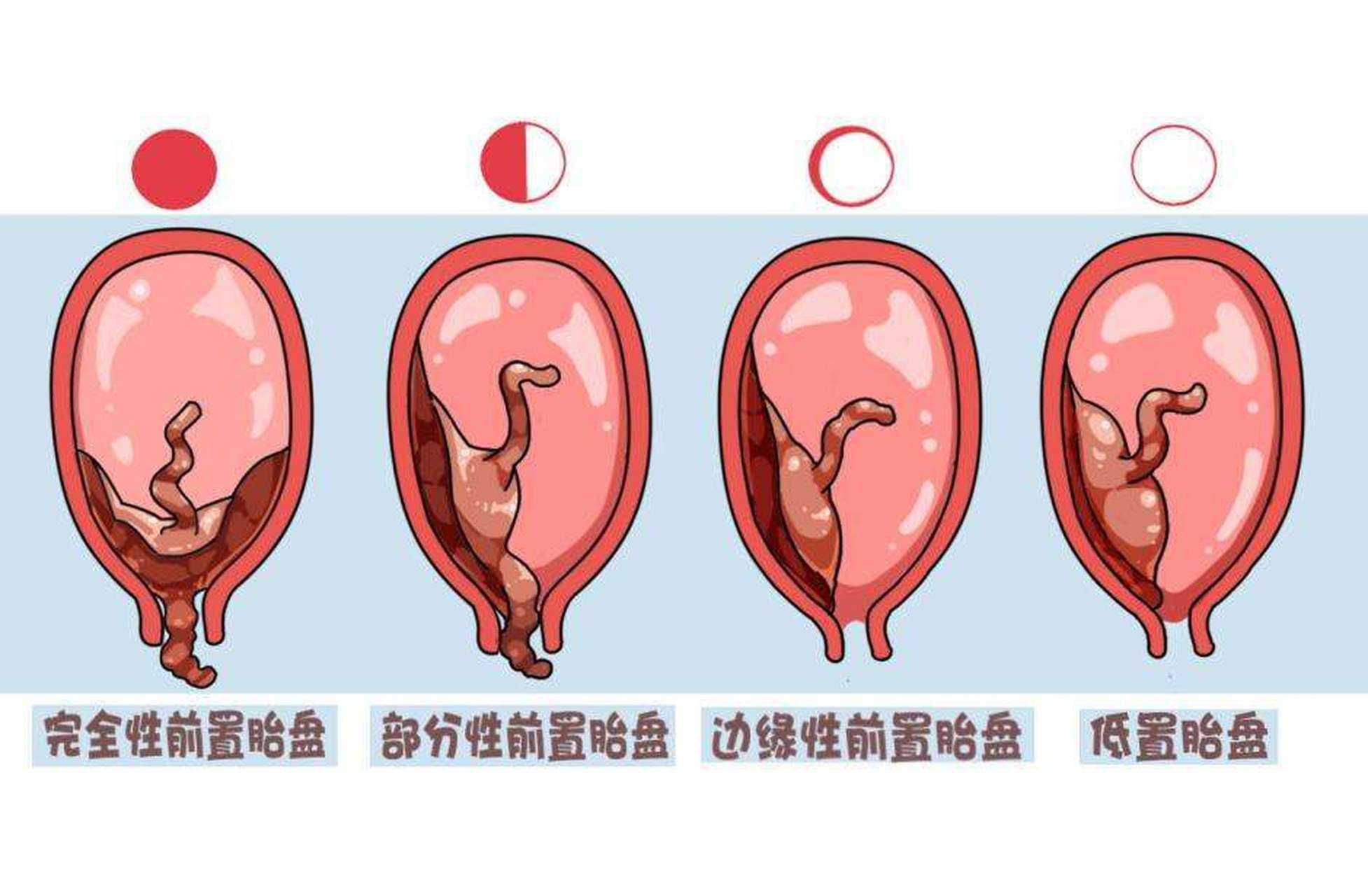 前置胎盘图片卡通图片