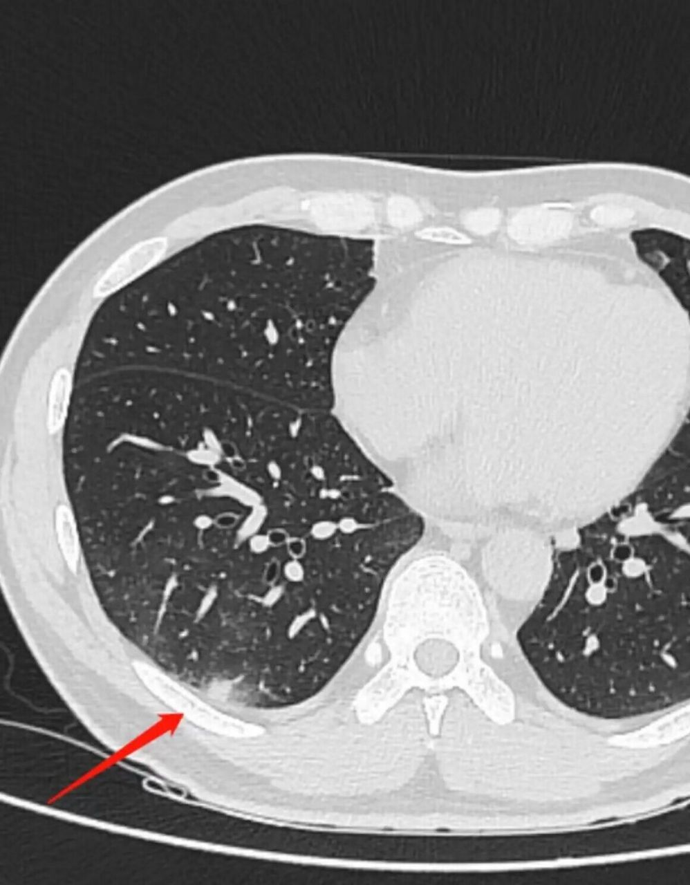 结节不用再担心了,这个小方子有奇效  张女士32岁,体检发现左肺上叶
